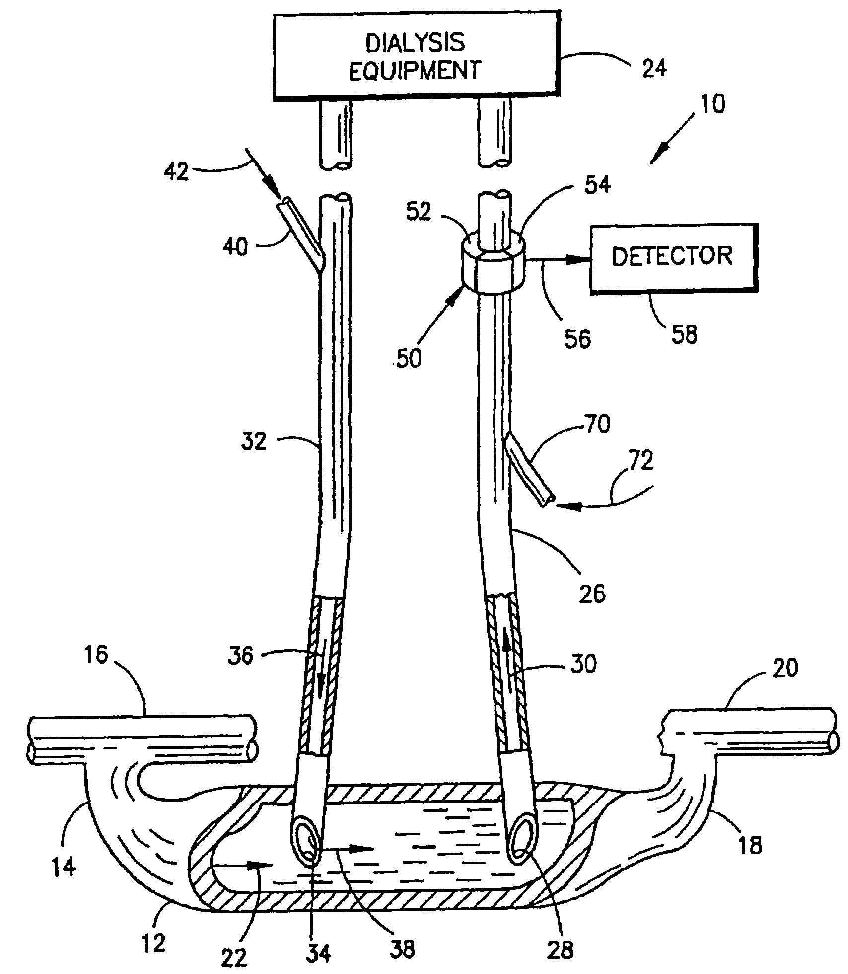 Measurement of a blood flow rate in hemodialysis shunts