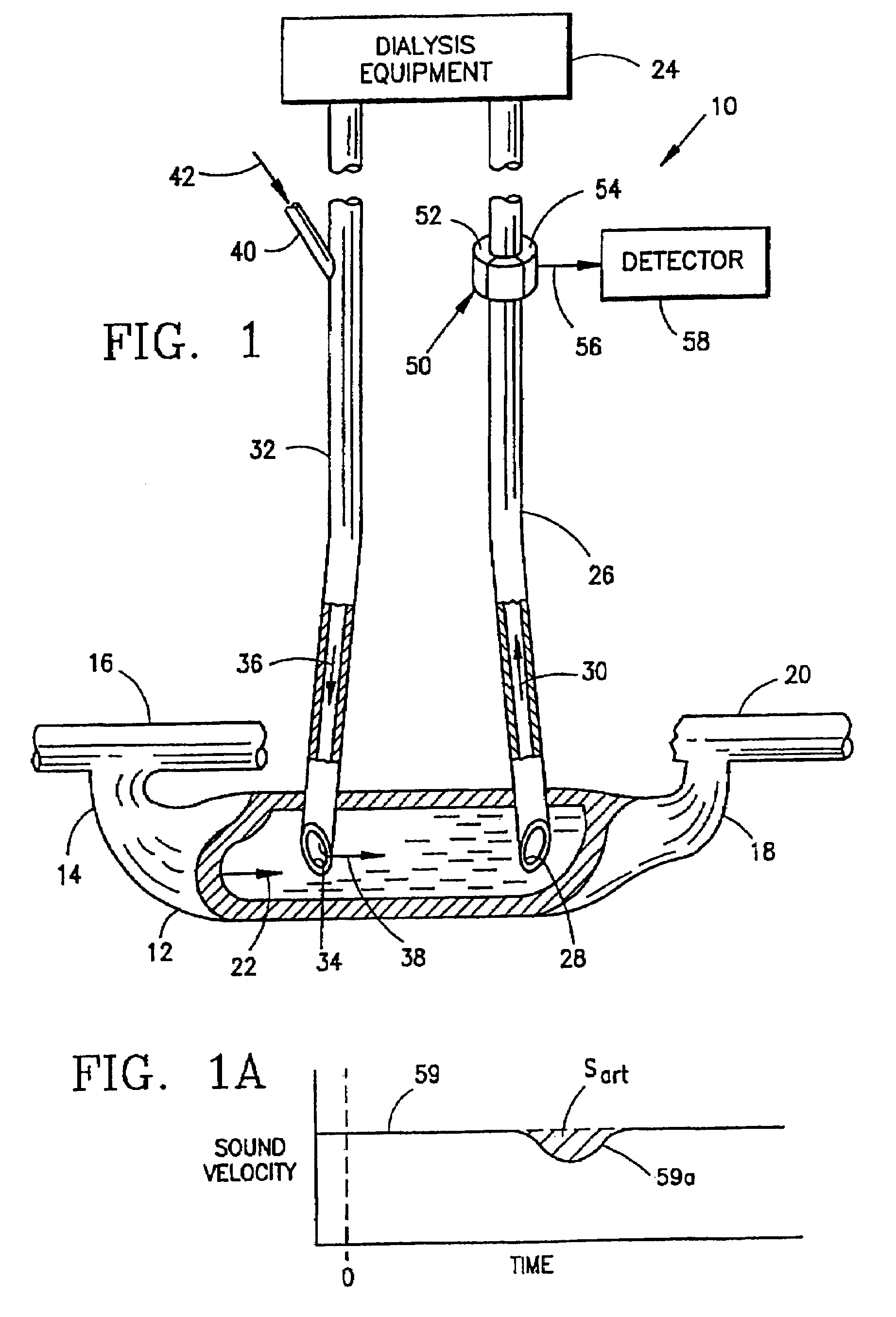 Measurement of a blood flow rate in hemodialysis shunts