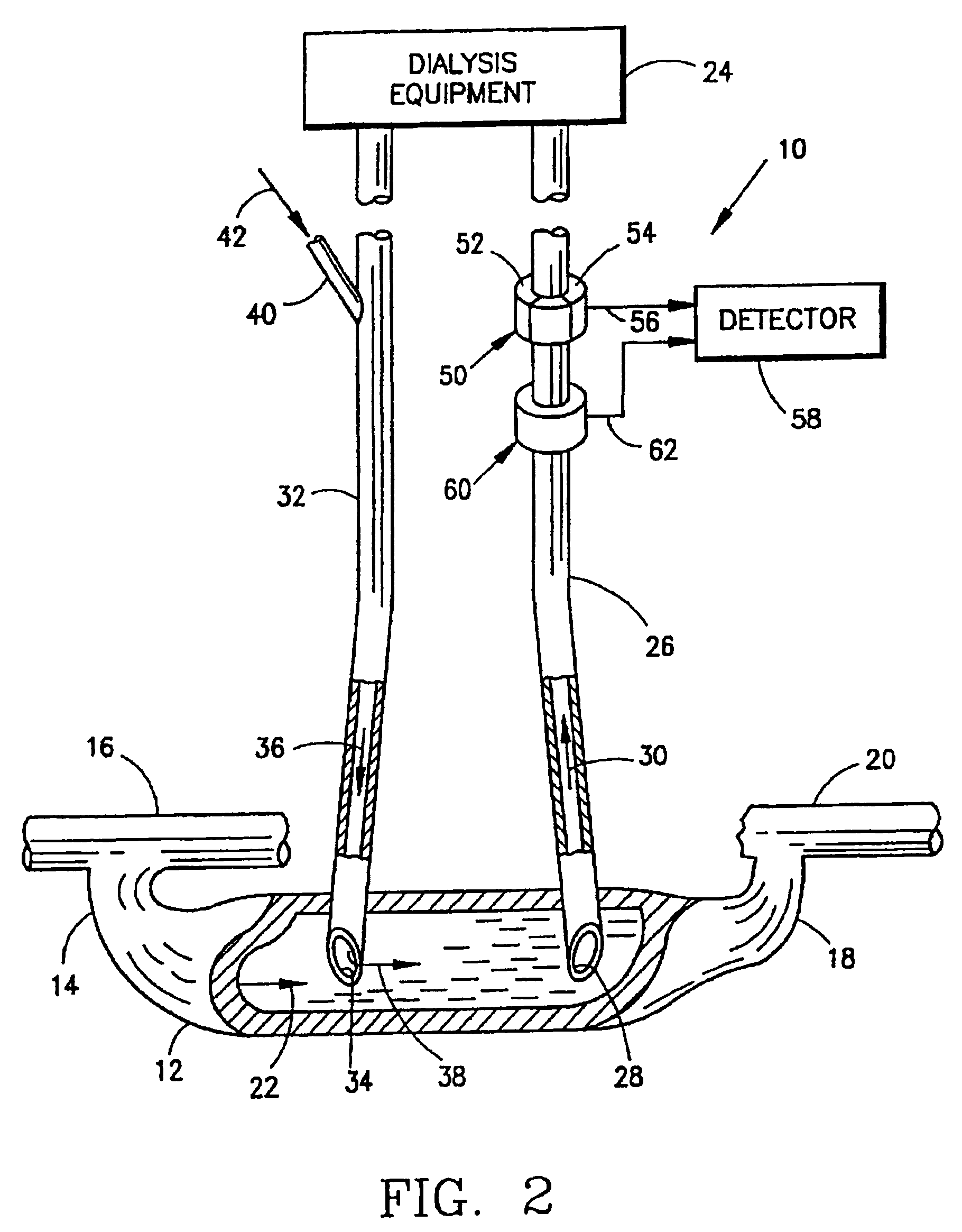 Measurement of a blood flow rate in hemodialysis shunts