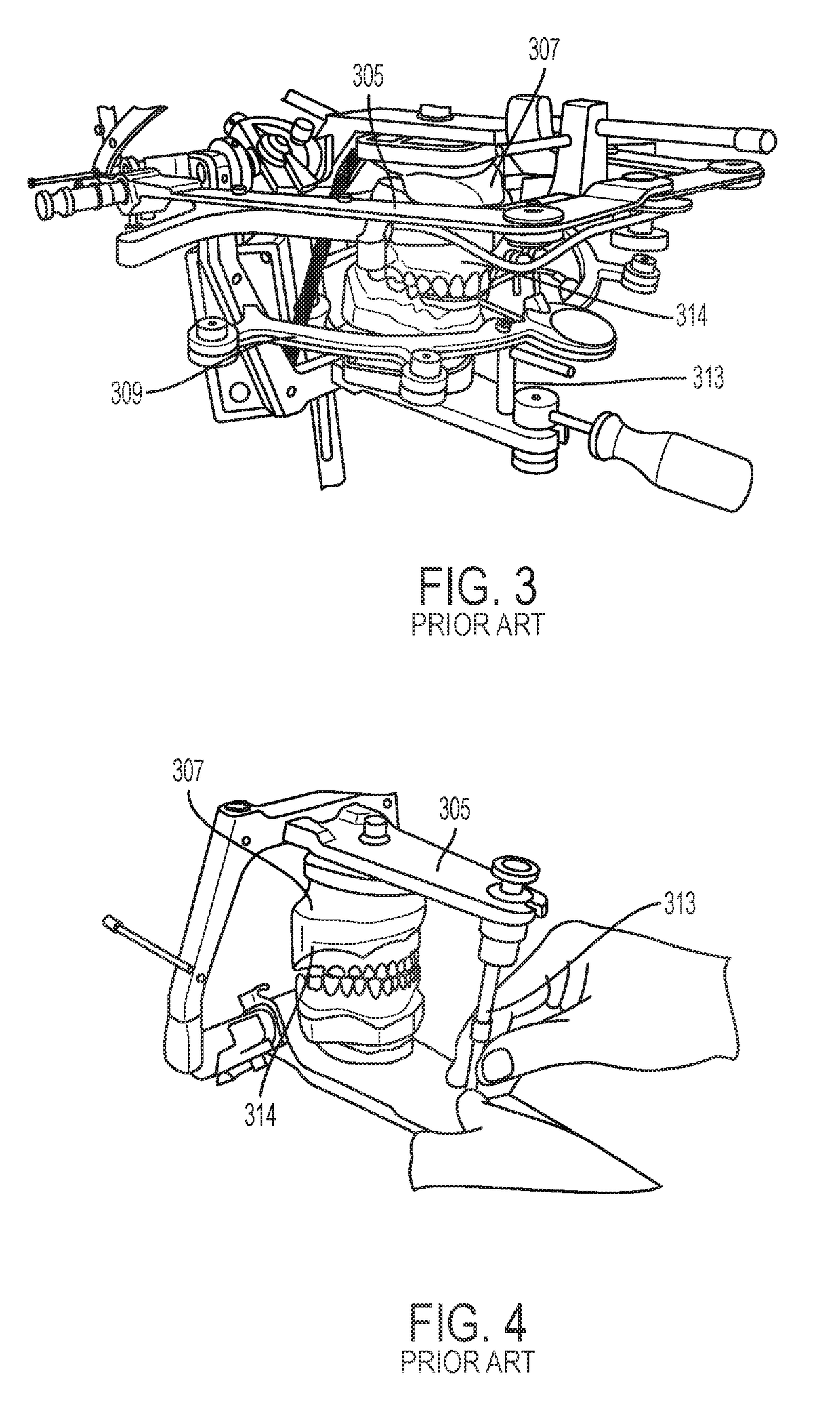 Anatomical articulator for dental diagonostic method and prosthetic reconstruction