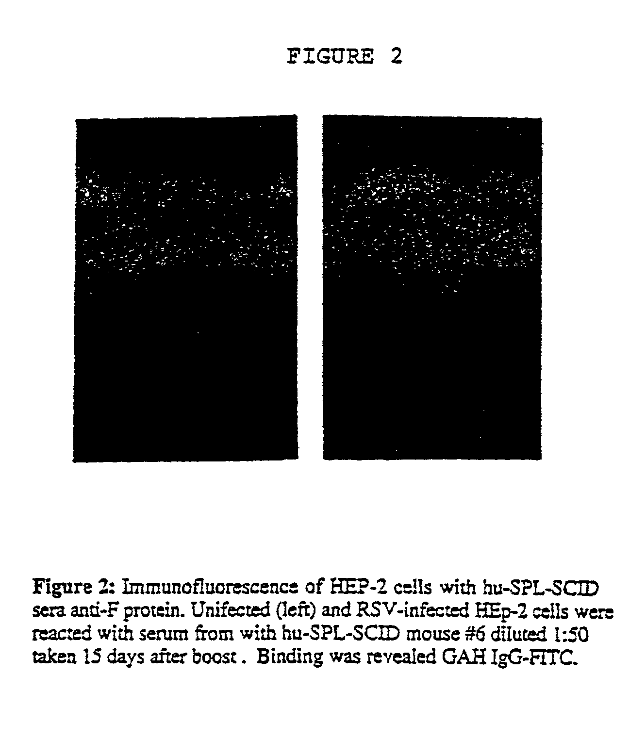 Neutralizing high affinity human monoclonal antibodies specific to rsv f-protein and methods for their manufacture and theraputic use thereof