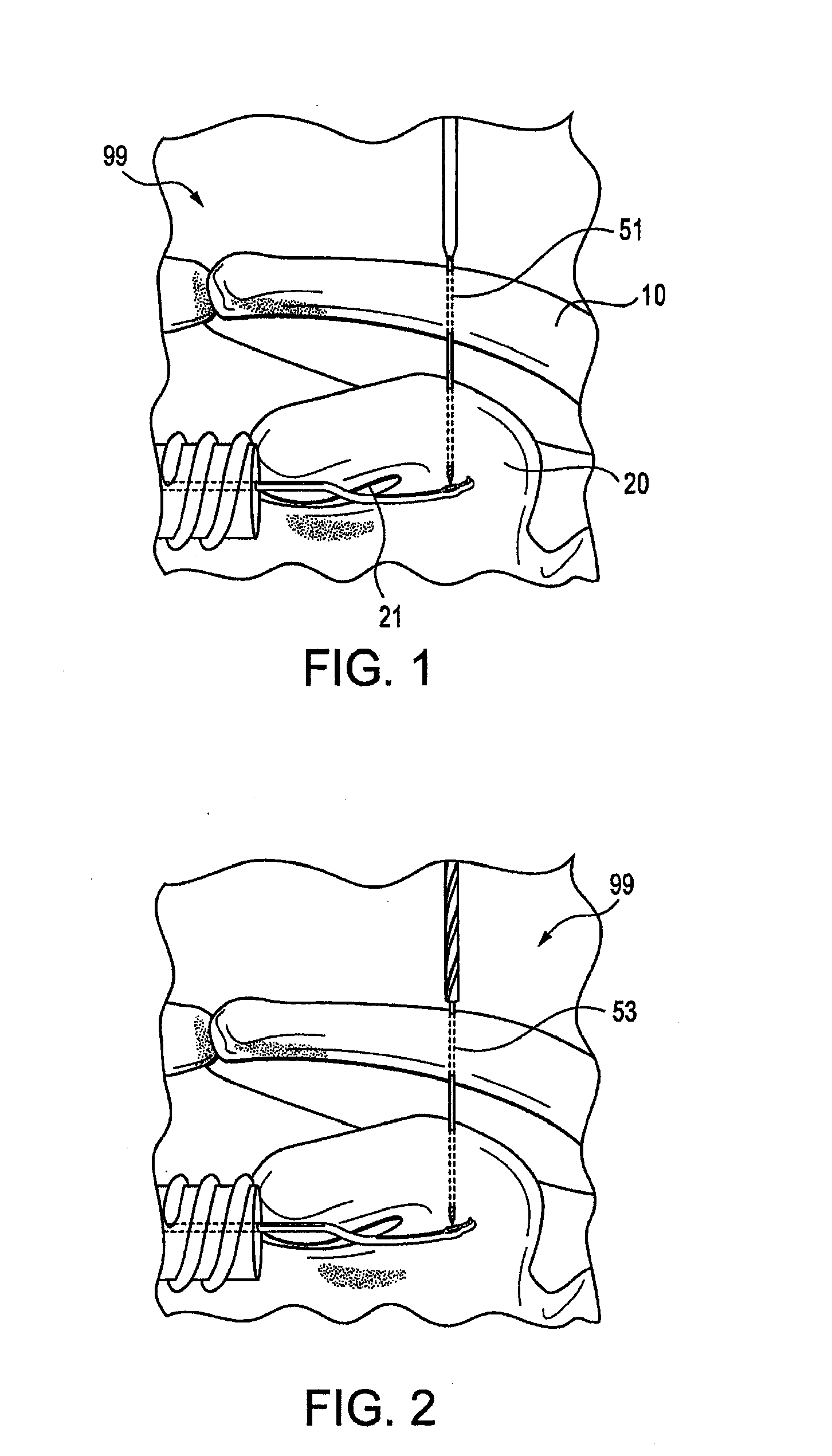 Acromioclavicular joint fixation technique