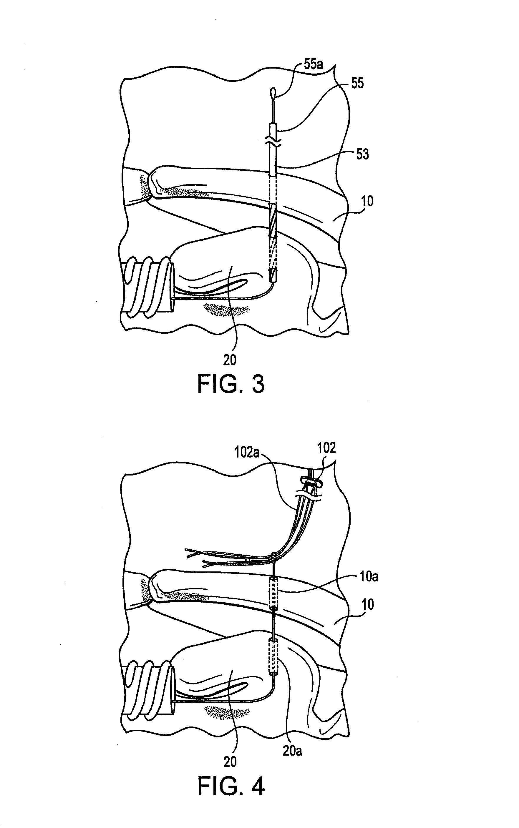 Acromioclavicular joint fixation technique