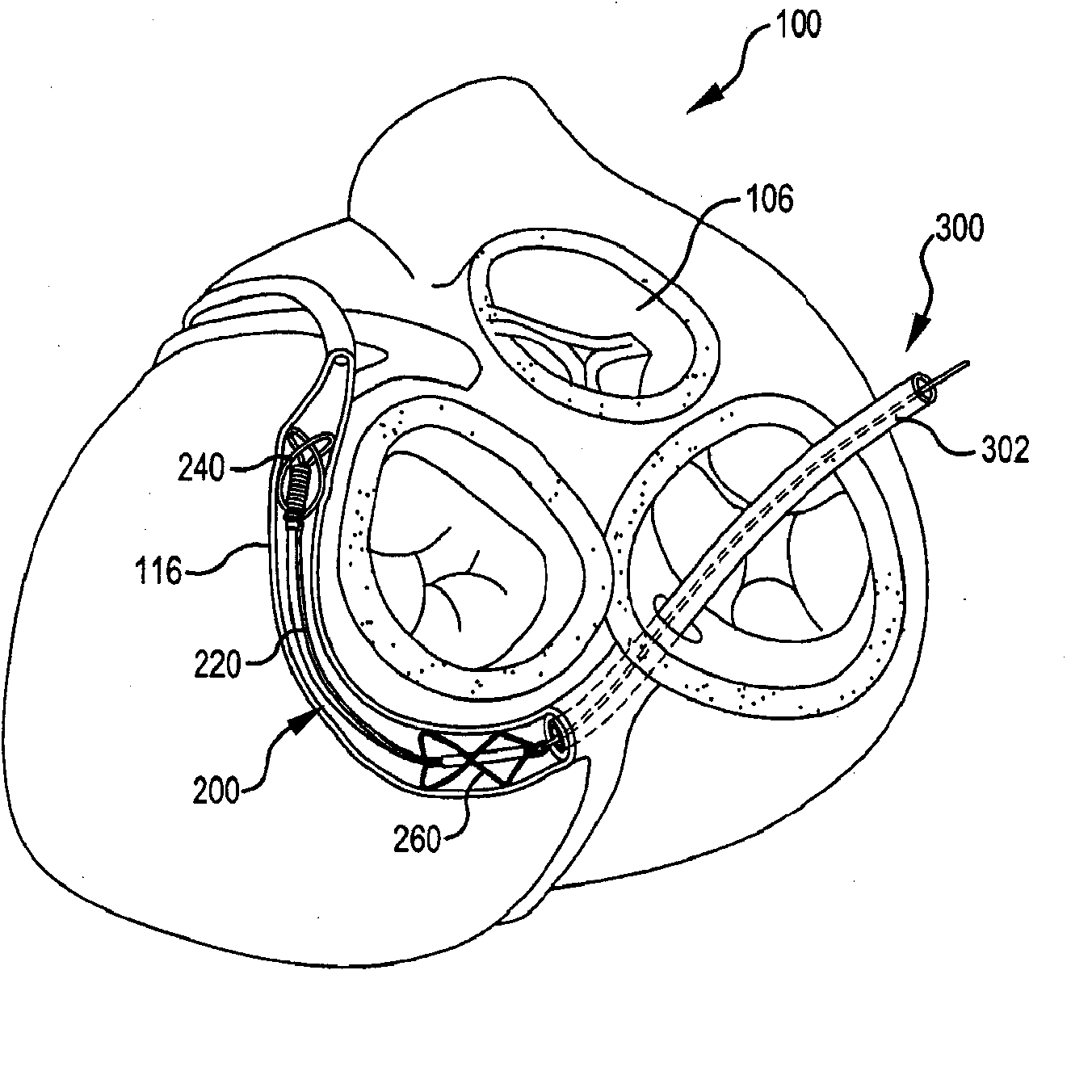 Body lumen shaping device with cardiac leads