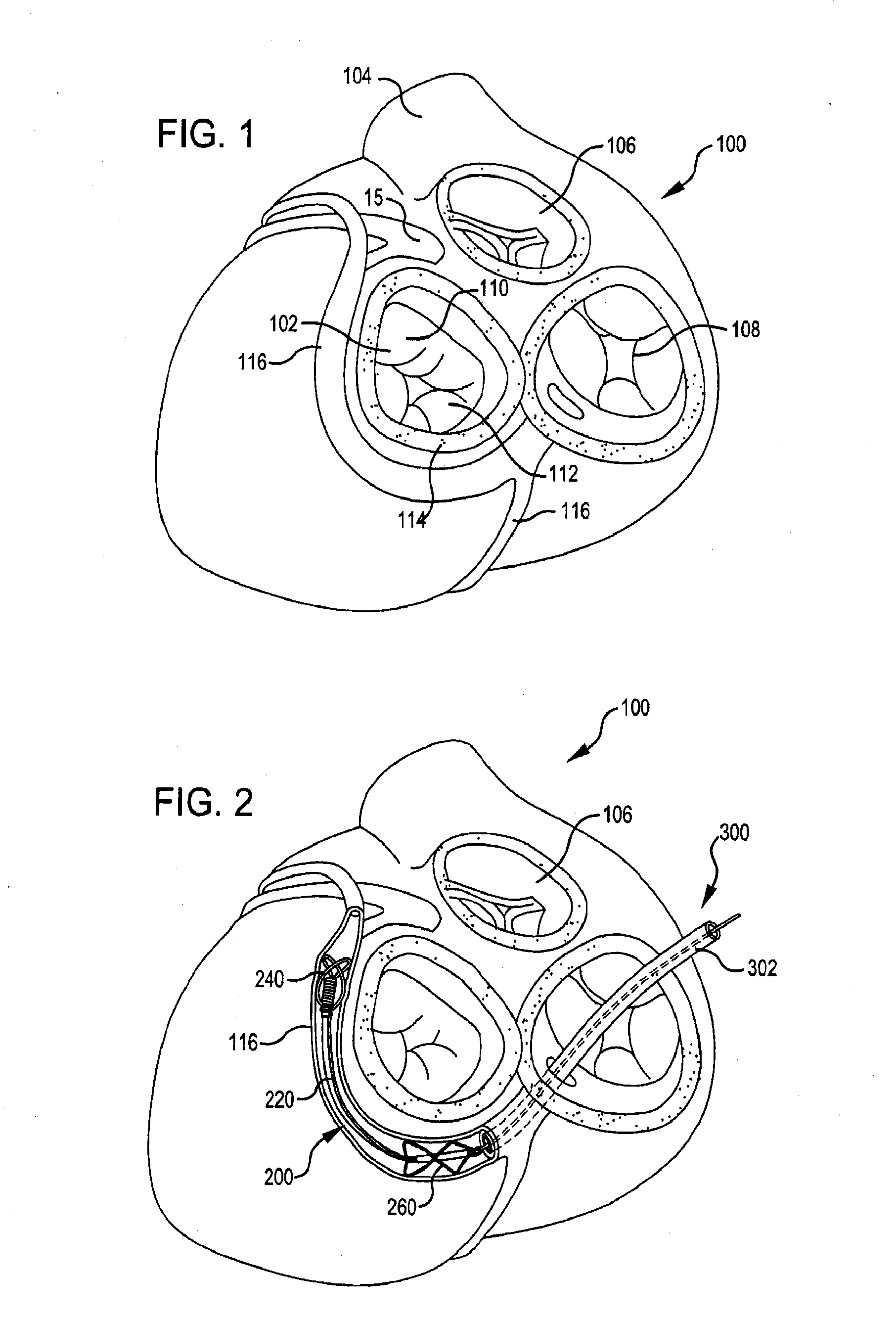 Body lumen shaping device with cardiac leads