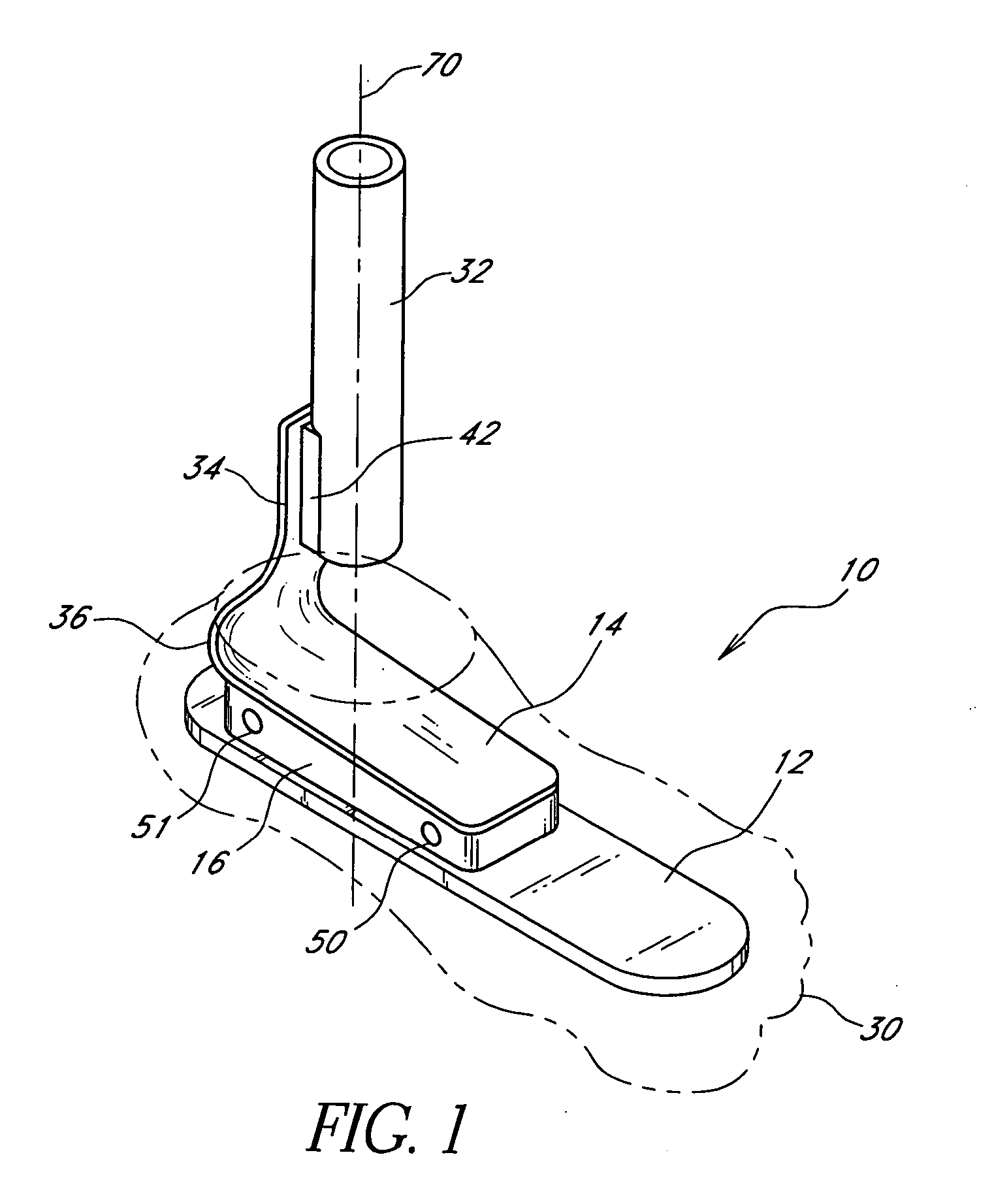 Foot prosthesis having cushioned ankle