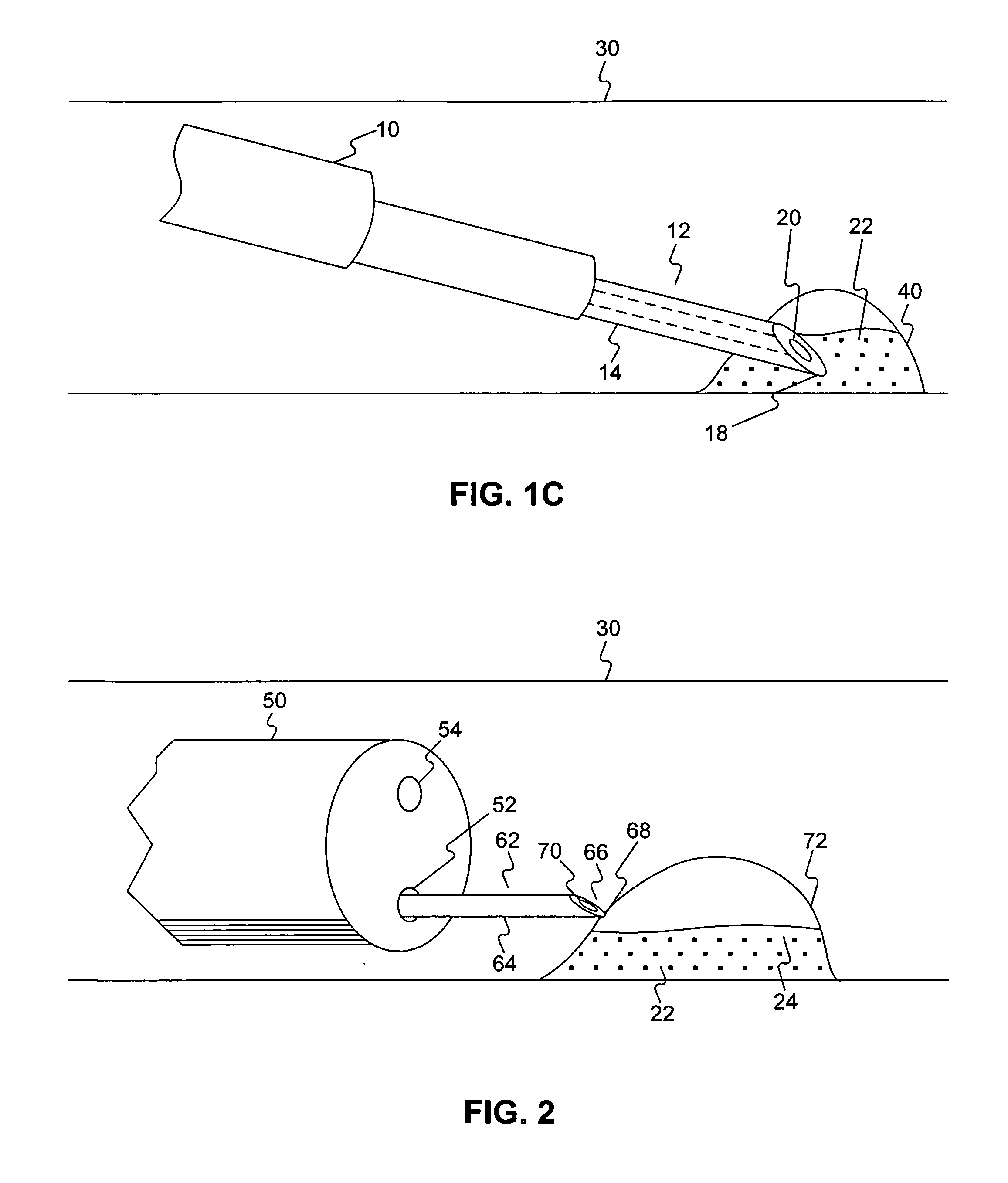 Endoscopic resection method