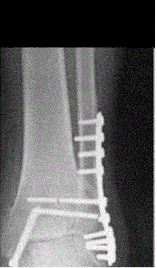 Telescopic tibiofibular syndesmosis fastening screw