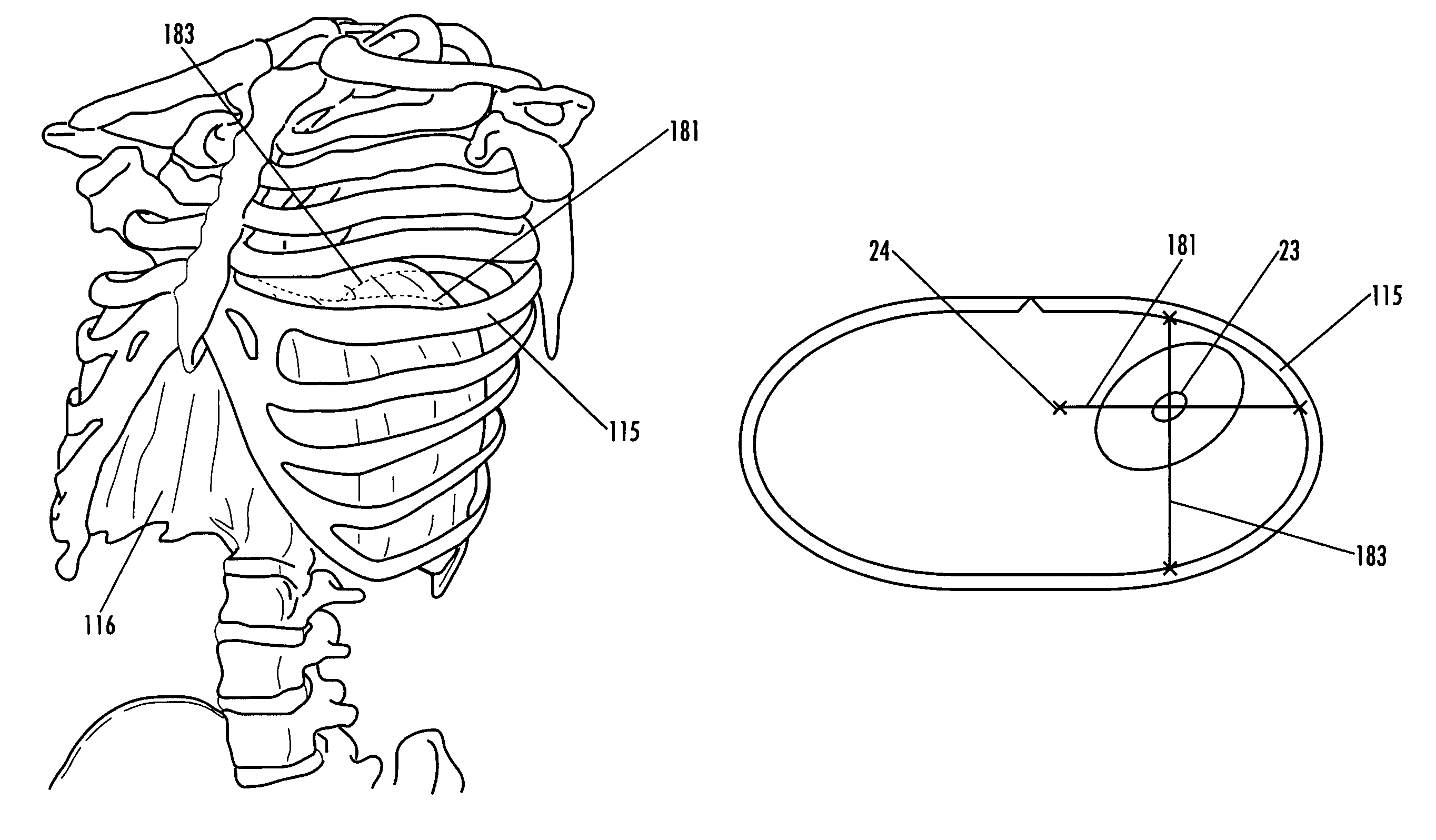 Devices and methods for treatment of obesity