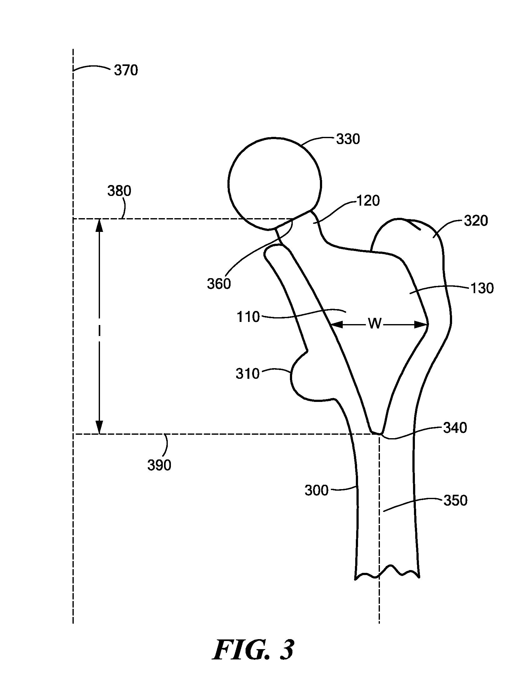 Proximally Self-Locking Long Bone Prosthesis