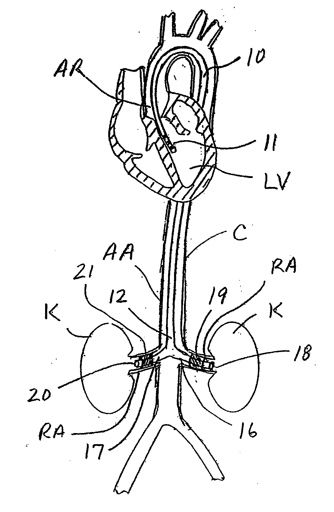 Apparatus and methods for treating congestive heart disease