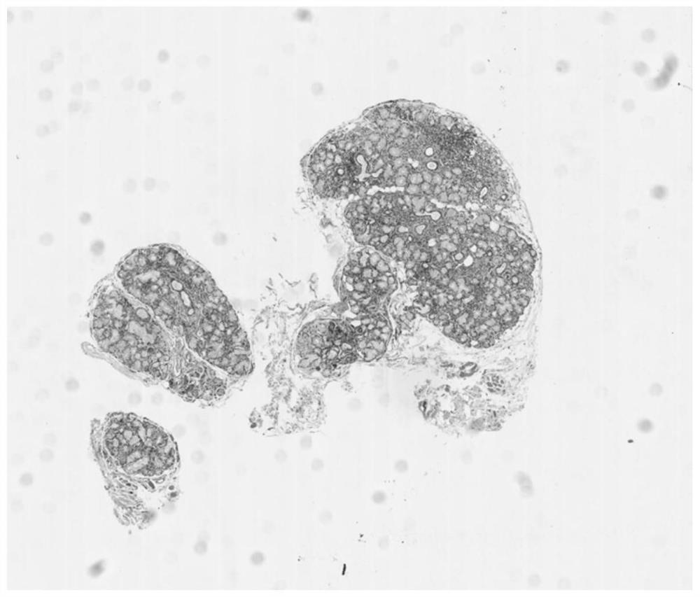 Intelligent analysis system and method for labial gland pathology