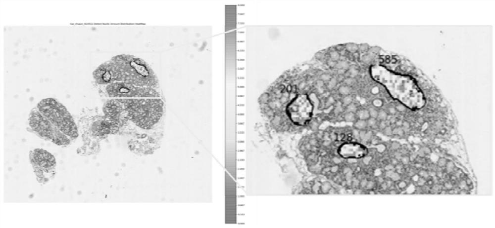 Intelligent analysis system and method for labial gland pathology