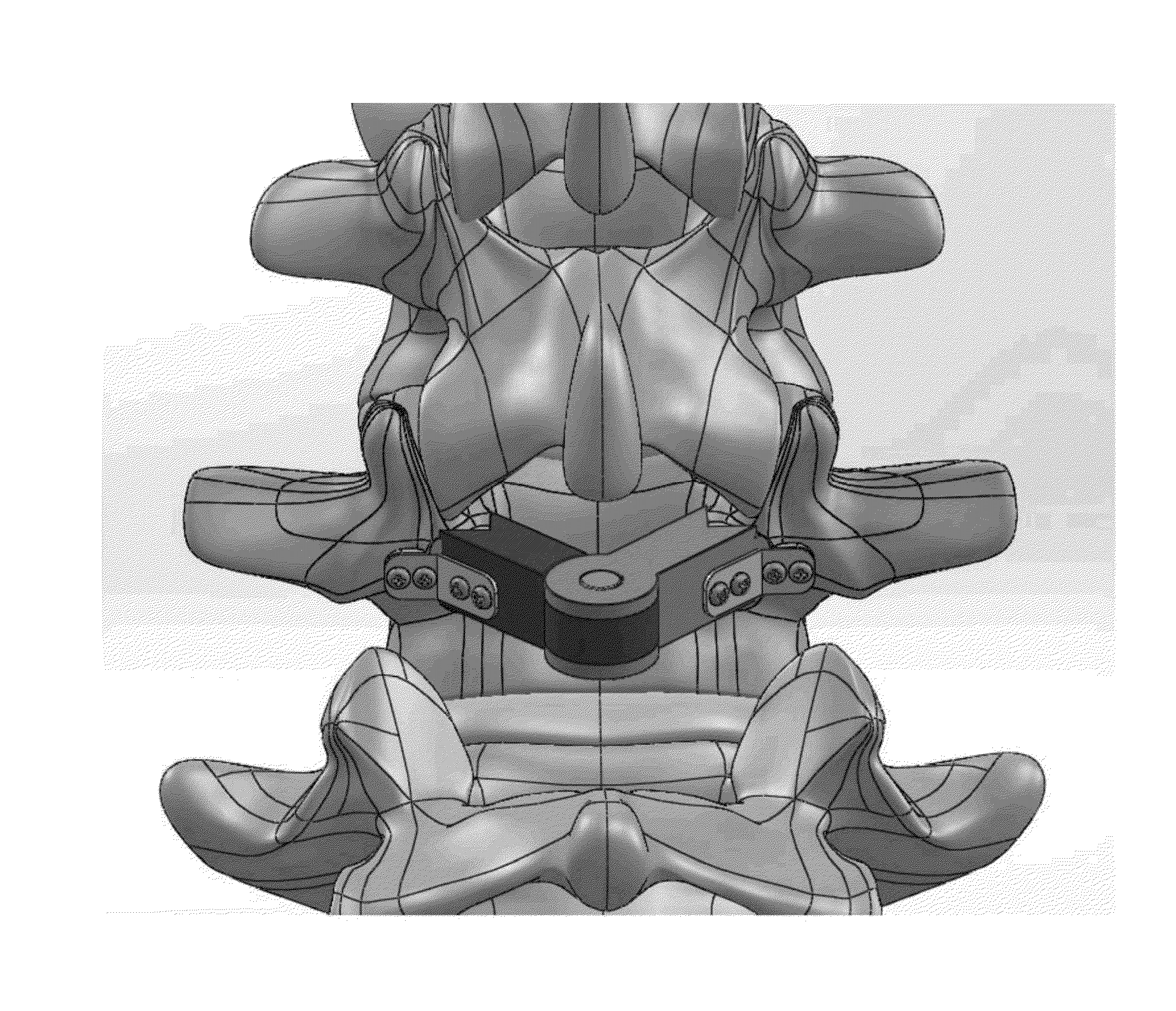 Lamina implant and method