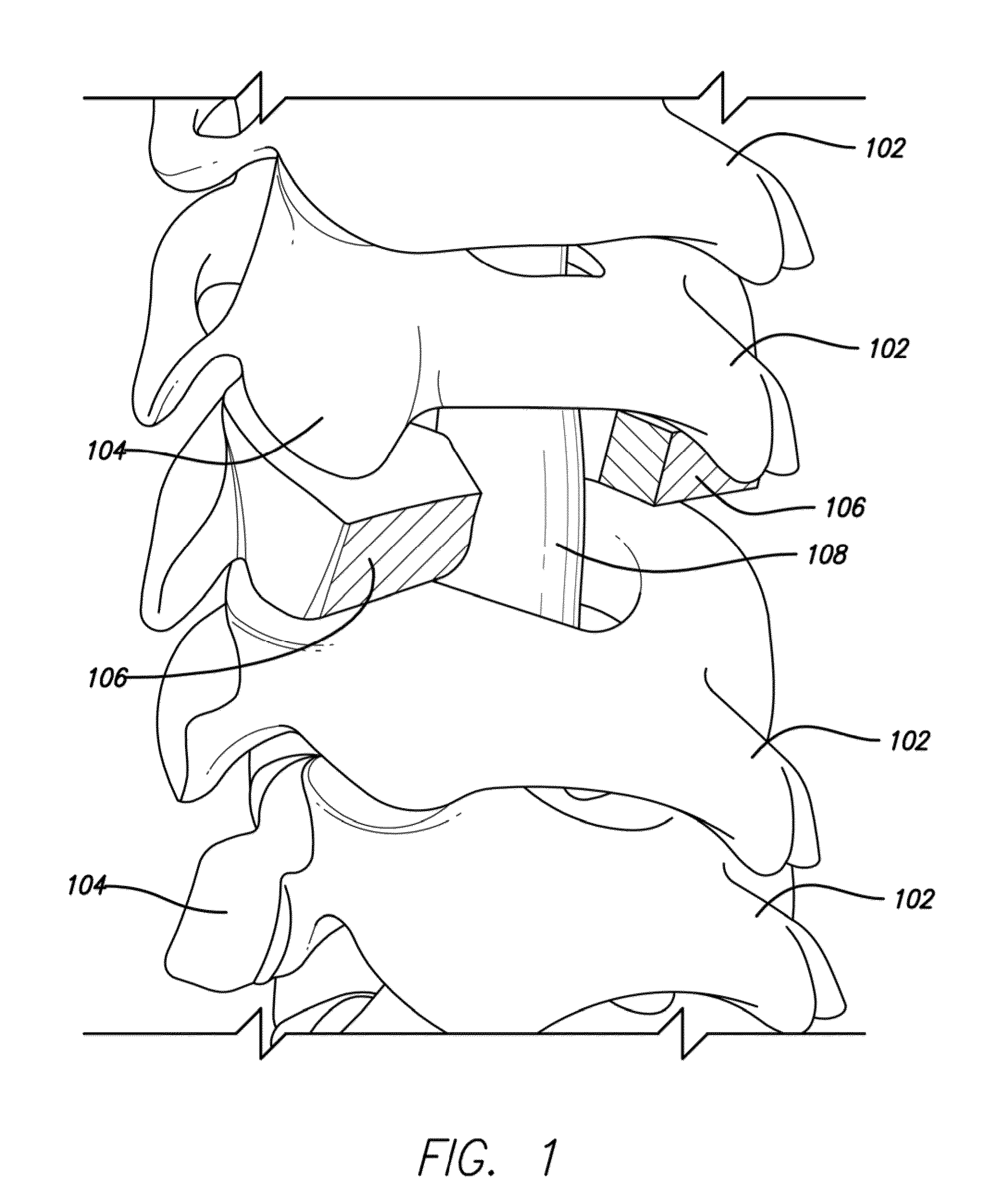 Lamina implant and method