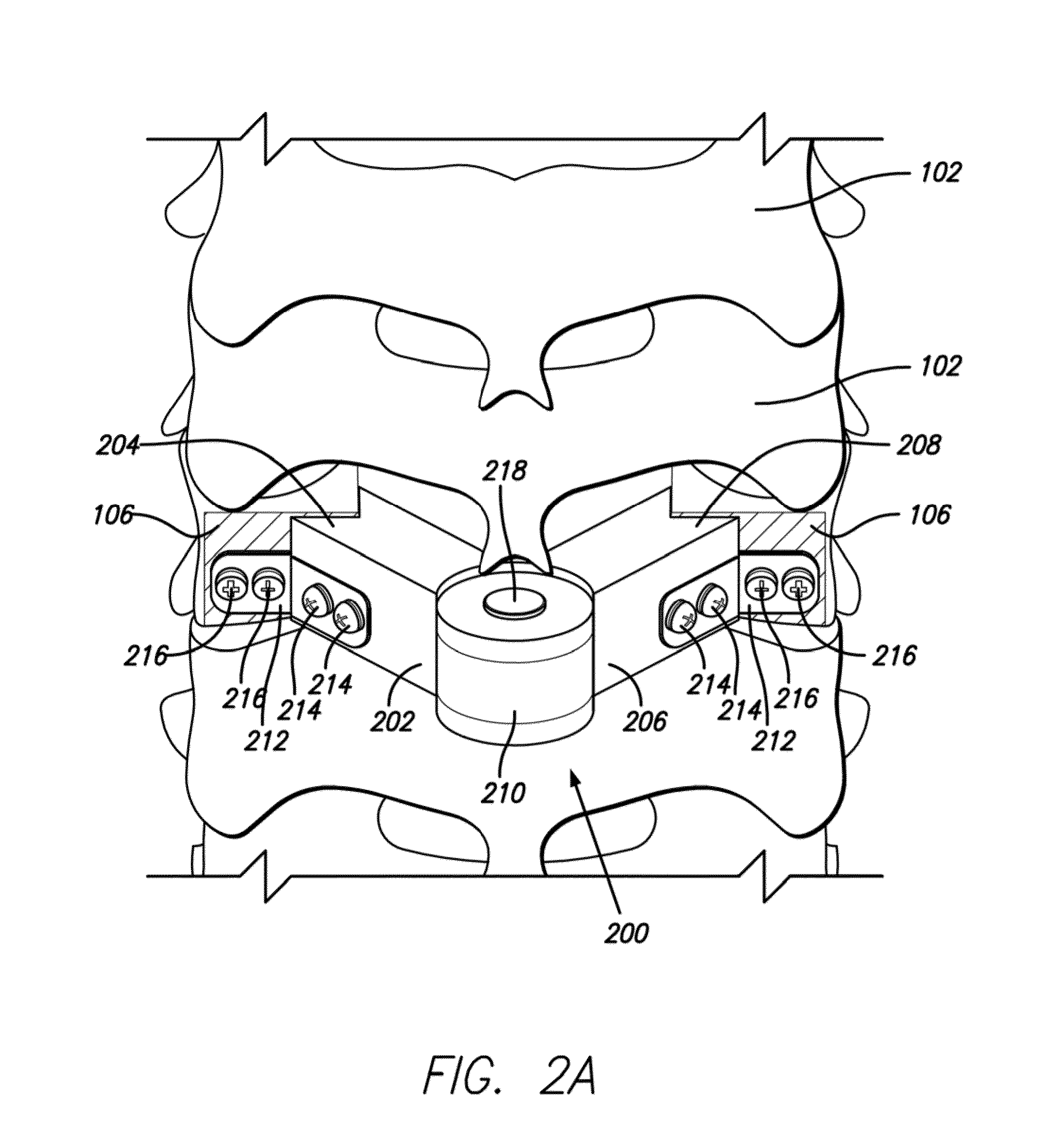 Lamina implant and method