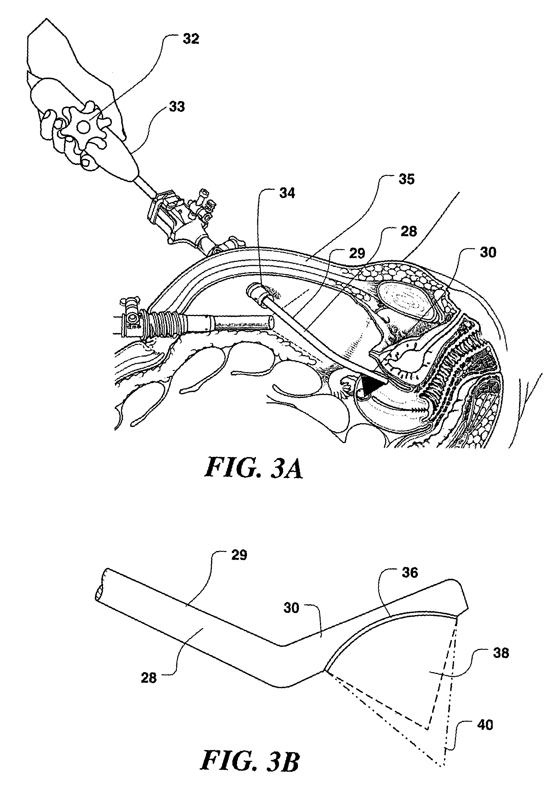 Controlled high efficiency lesion formation using high intensity ultrasound