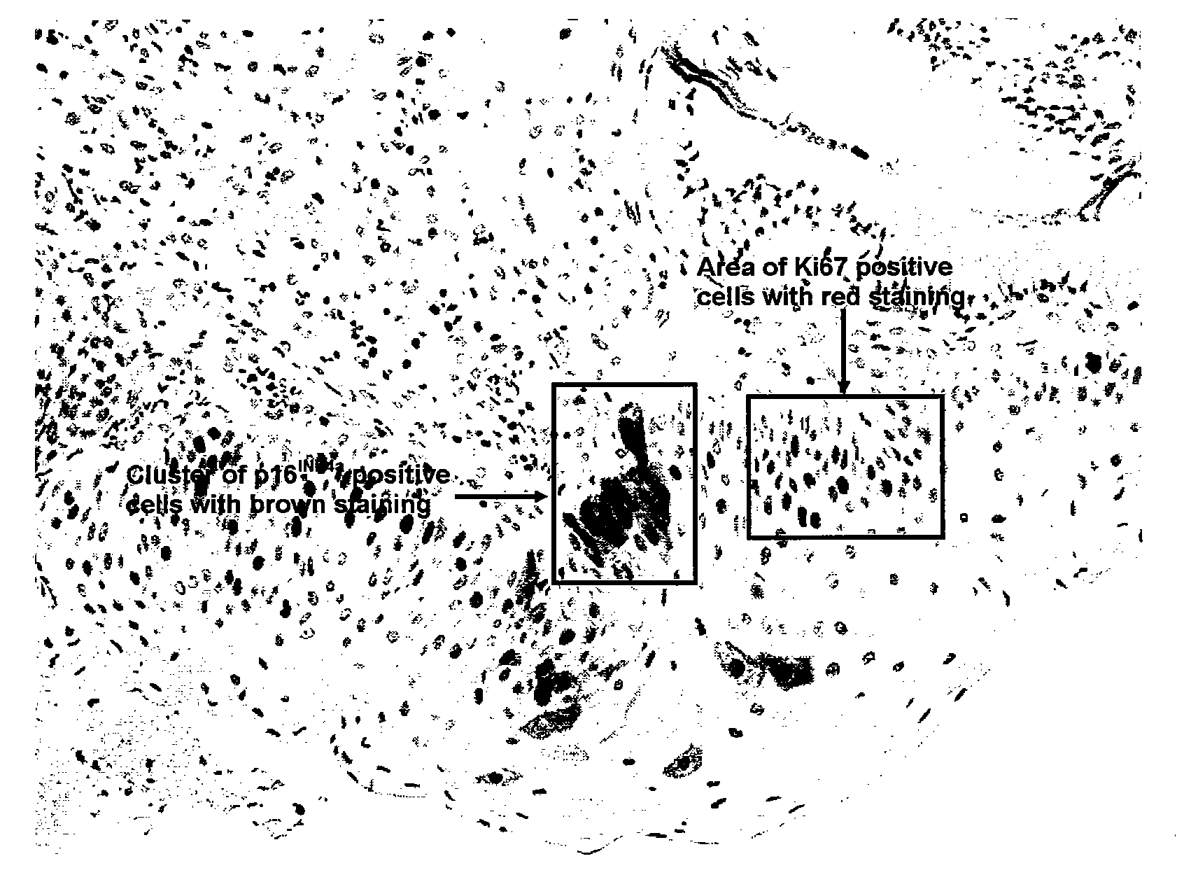 Method for prediction of the progression risk of tumors