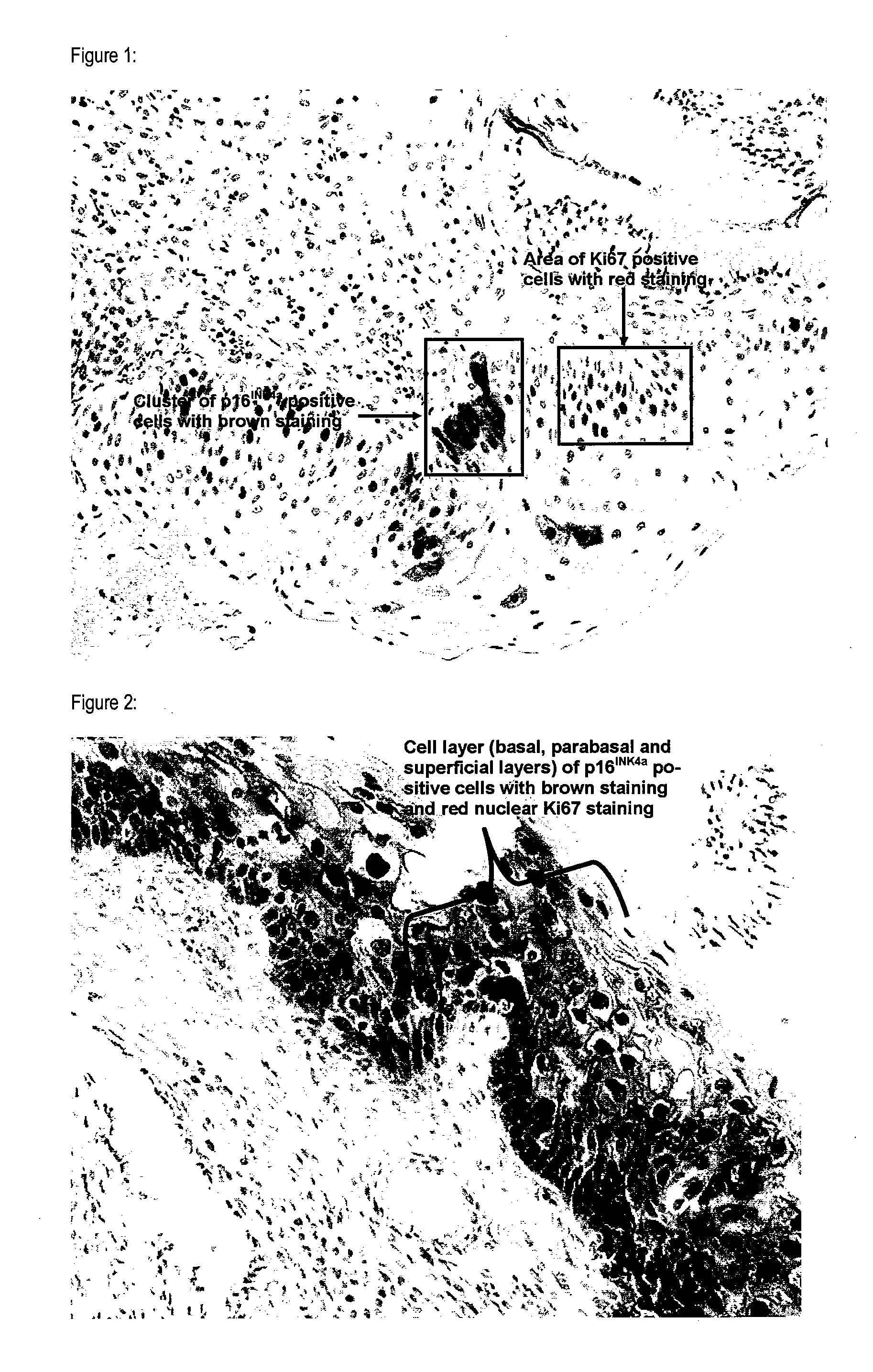 Method for prediction of the progression risk of tumors