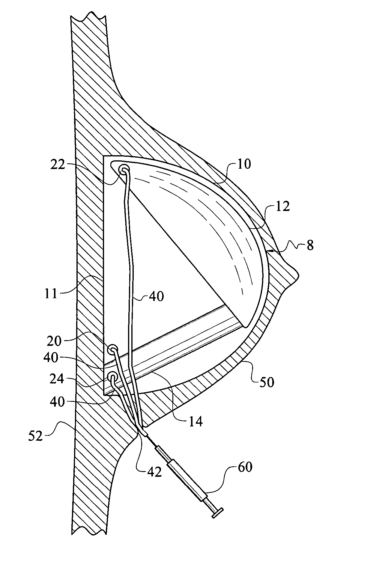 Method and apparatus for reconstructive surgery