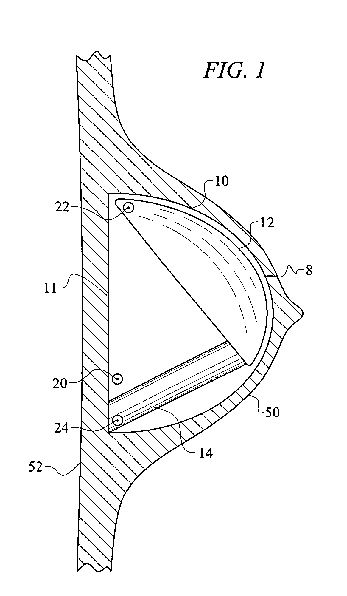 Method and apparatus for reconstructive surgery