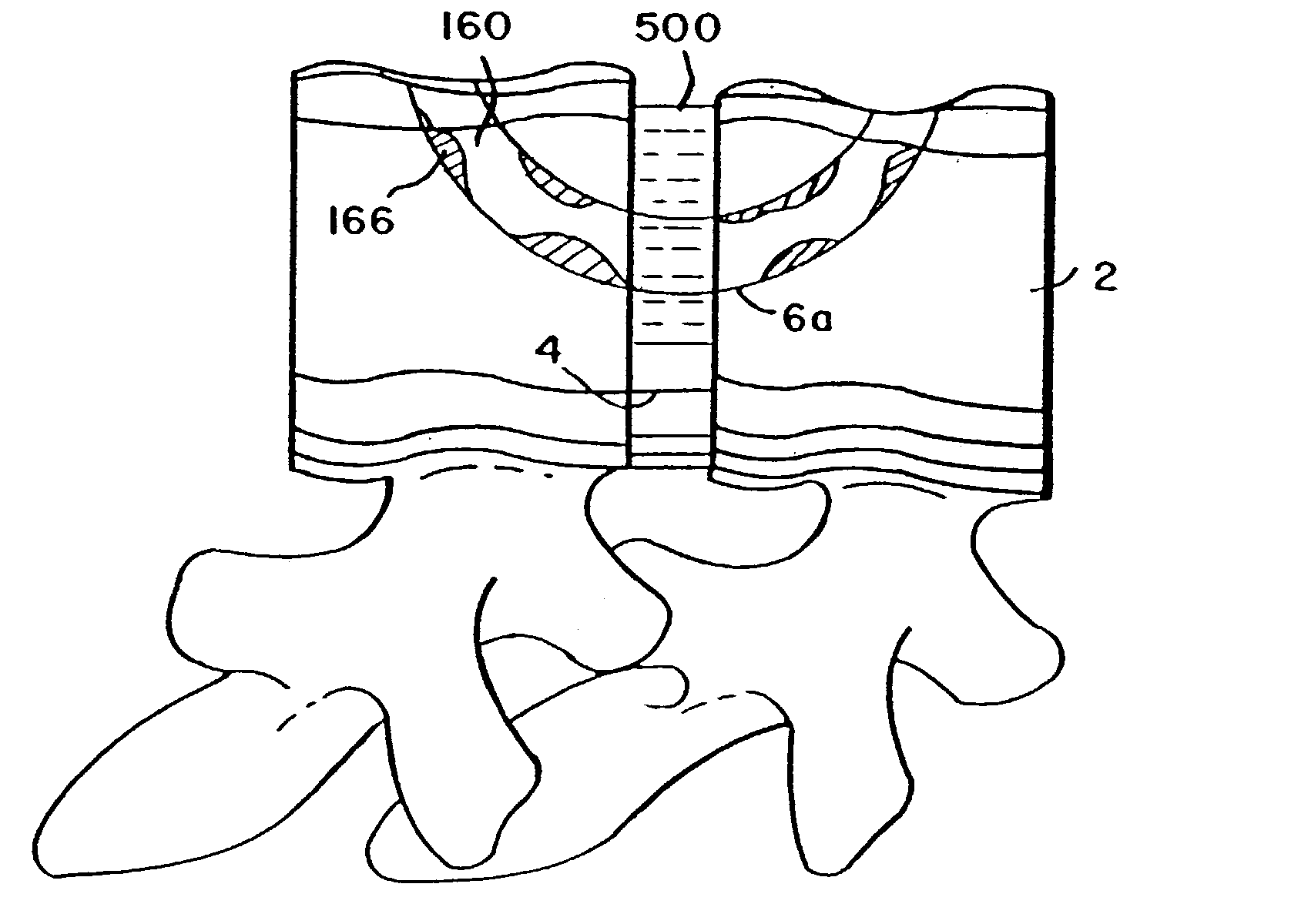 Systems, methods, devices and device kits for fixation of bones and spinal vertebrae