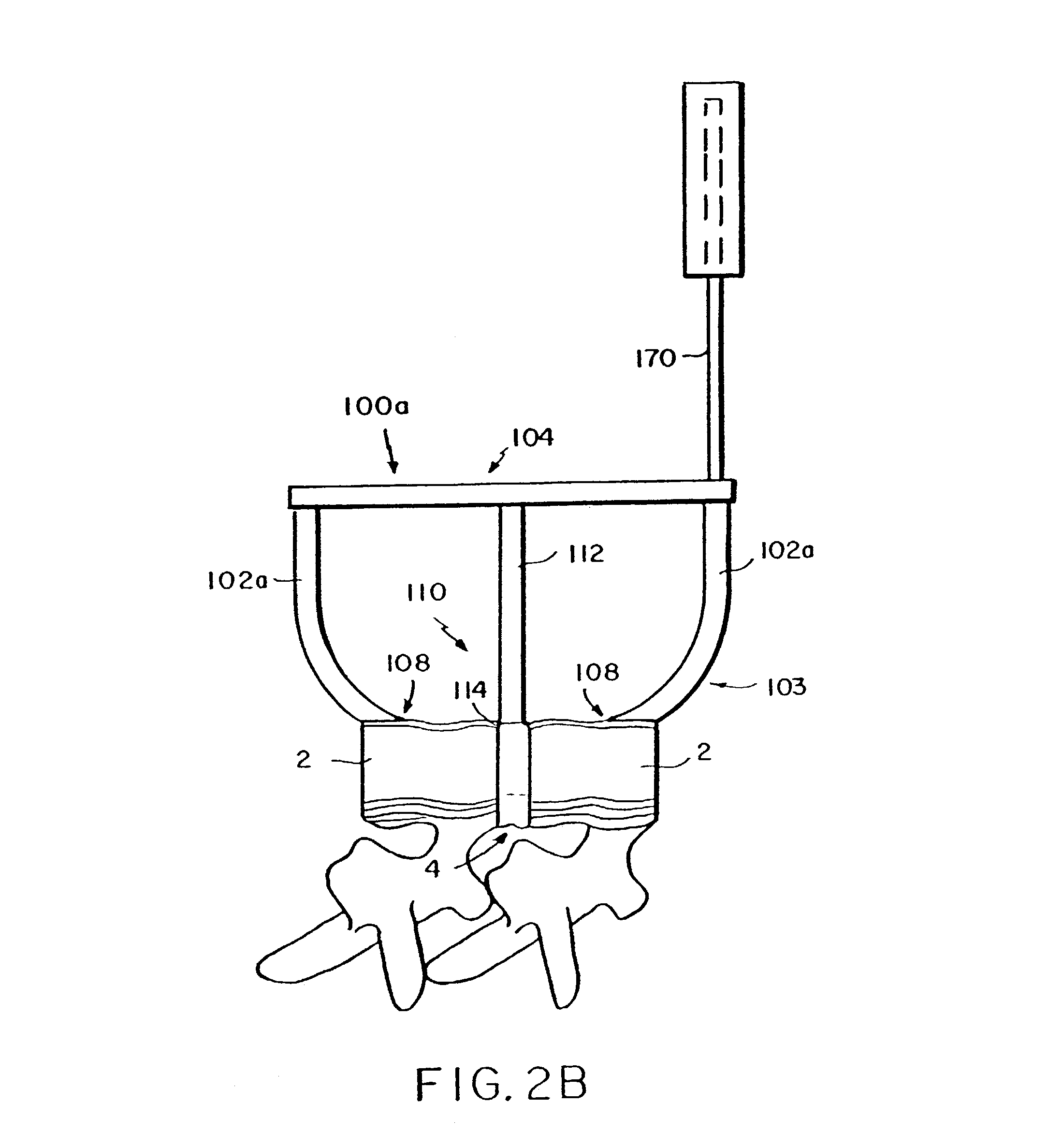 Systems, methods, devices and device kits for fixation of bones and spinal vertebrae