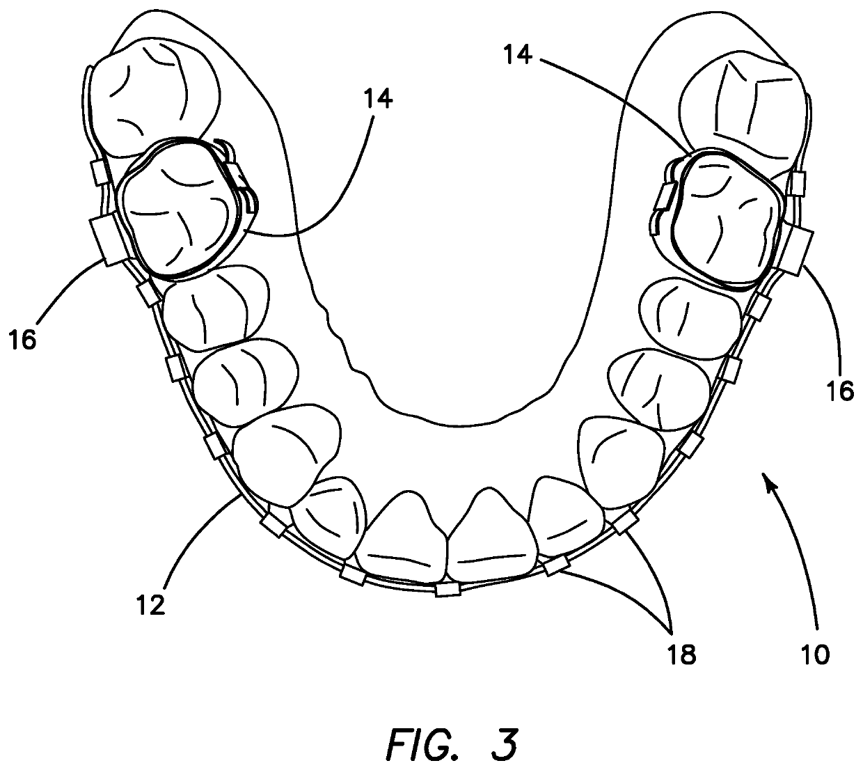 Orthodontic Appliance for Use During Orthognathic Surgery and Method for Using the Same