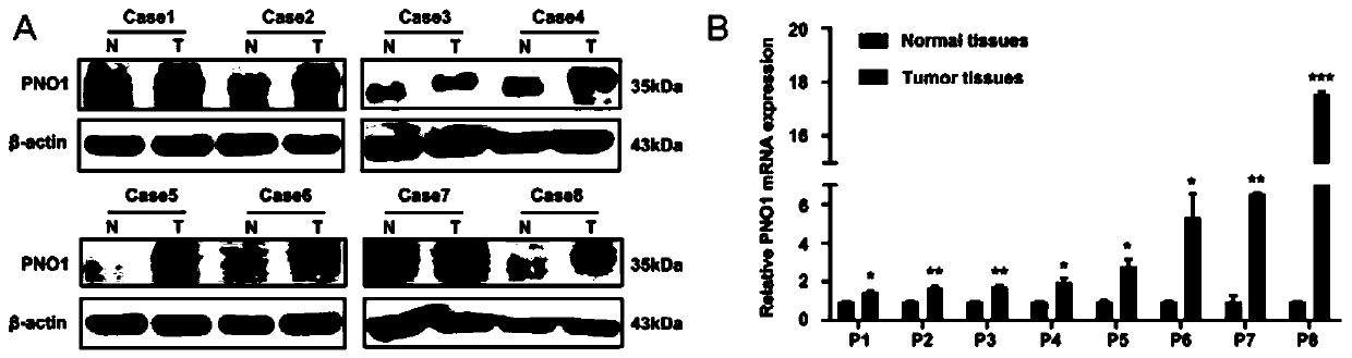 Application of human PNO1 gene in lung cancer and related product