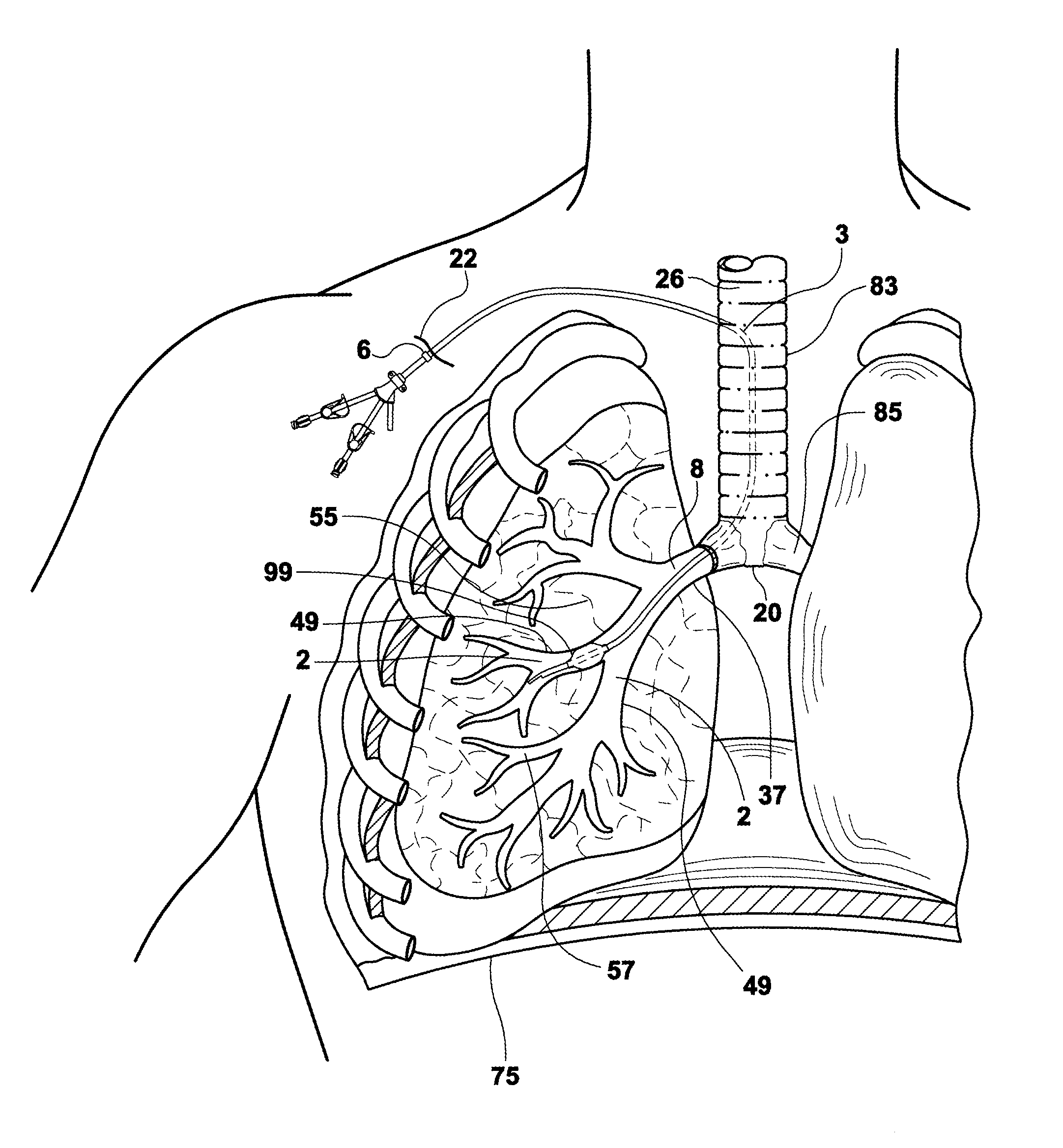 Bronchial catheter and method of use