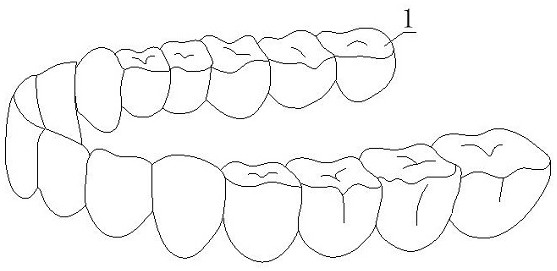 A spliced ​​metal denture and manufacturing method thereof