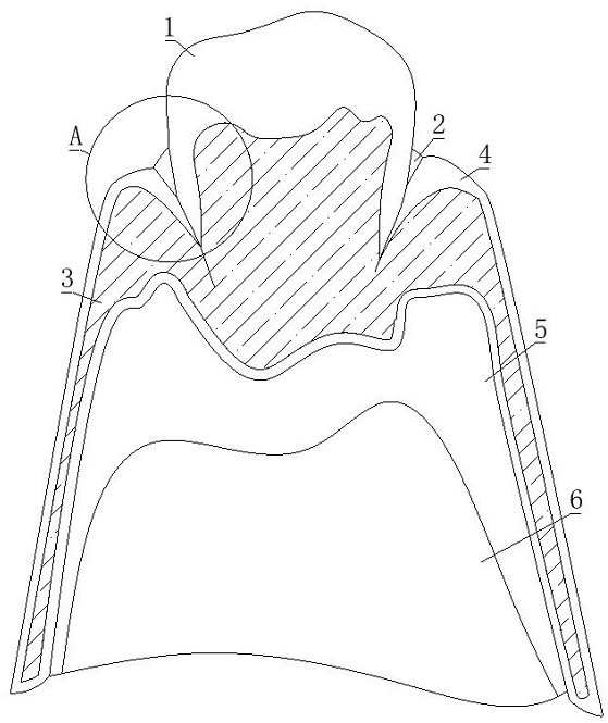 A spliced ​​metal denture and manufacturing method thereof