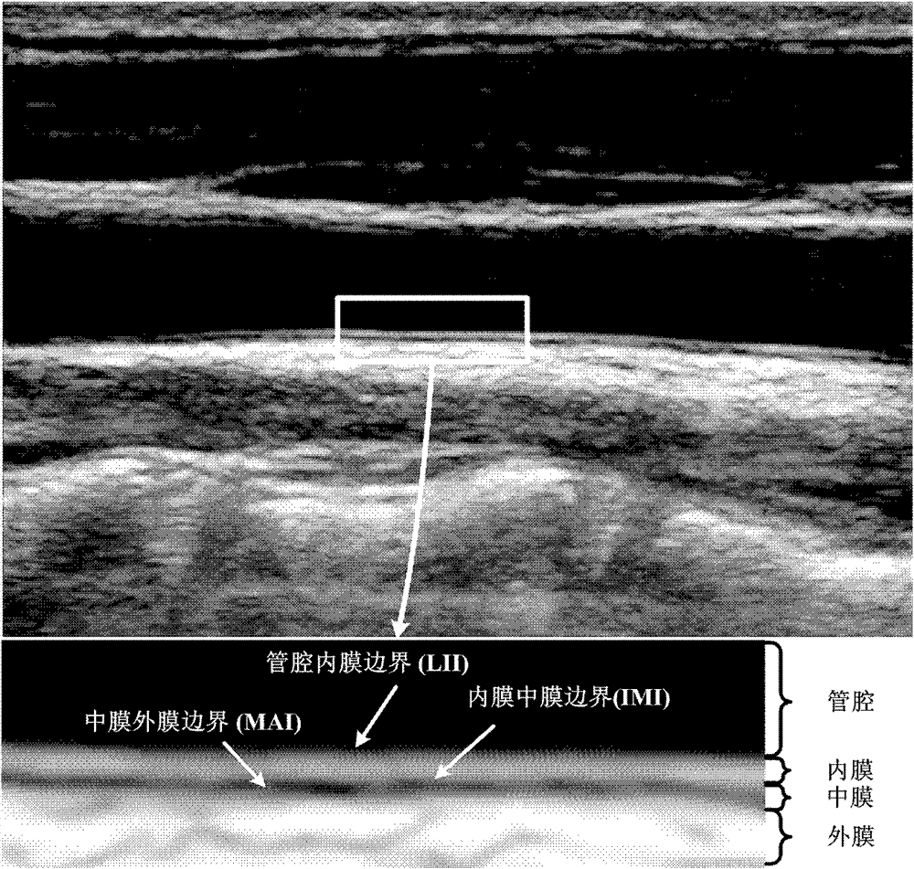 Method for automatic computerized segmentation and analysis on thickness uniformity of intima media of carotid artery blood wall in sonographic image