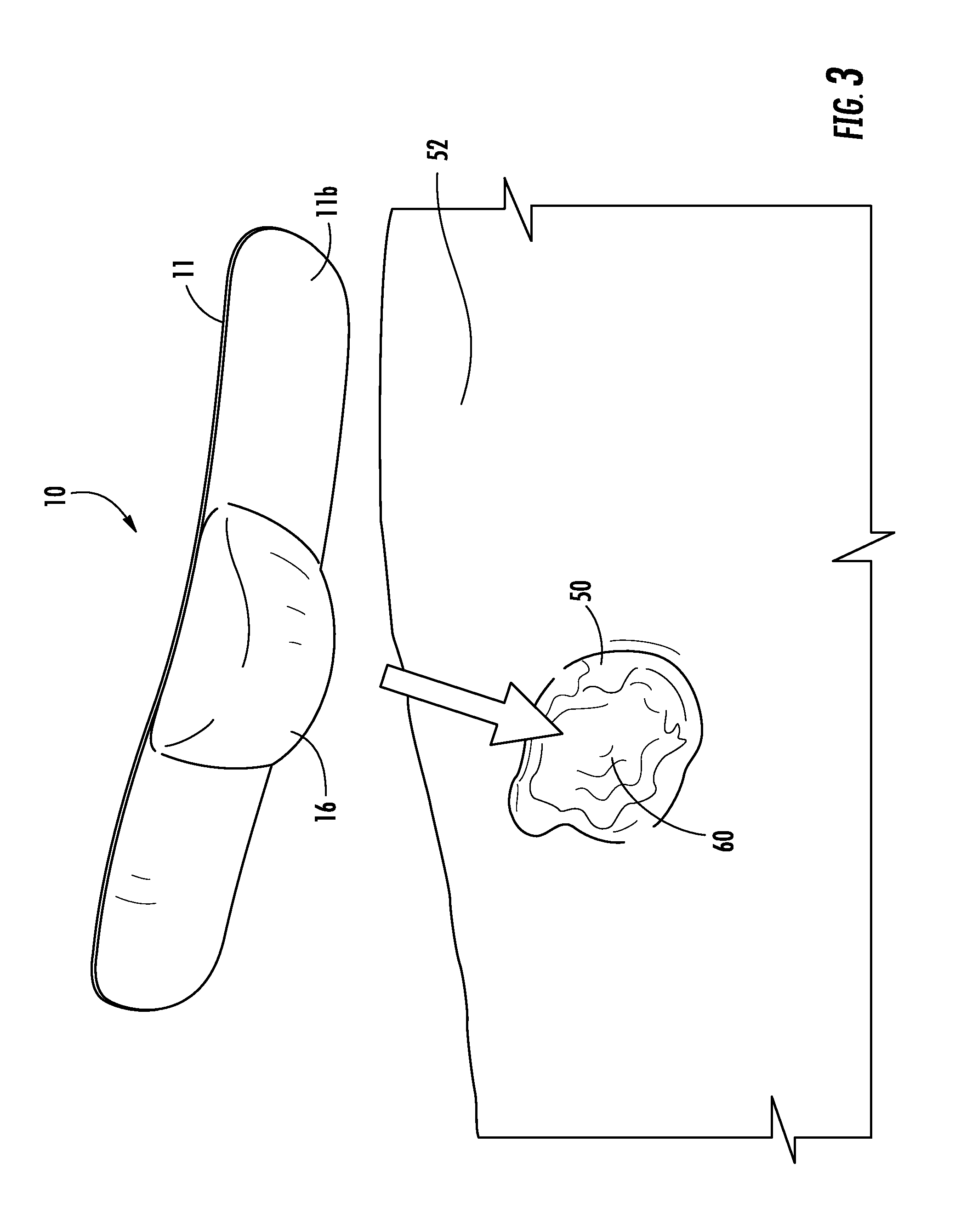 Bandage and method of using same