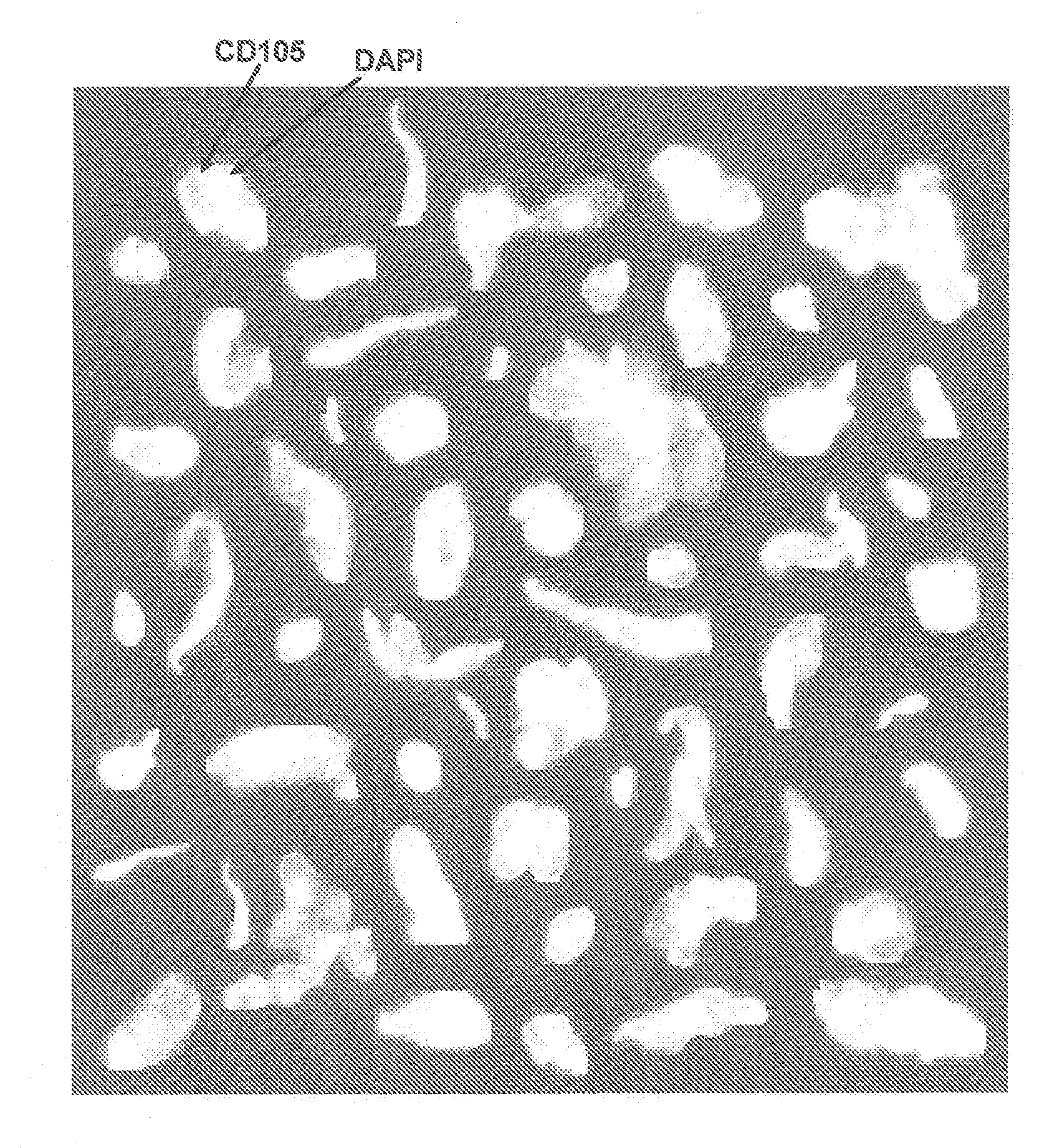 Method of assessing metastatic carcinomas from circulating endothelial cells and disseminated tumor cells