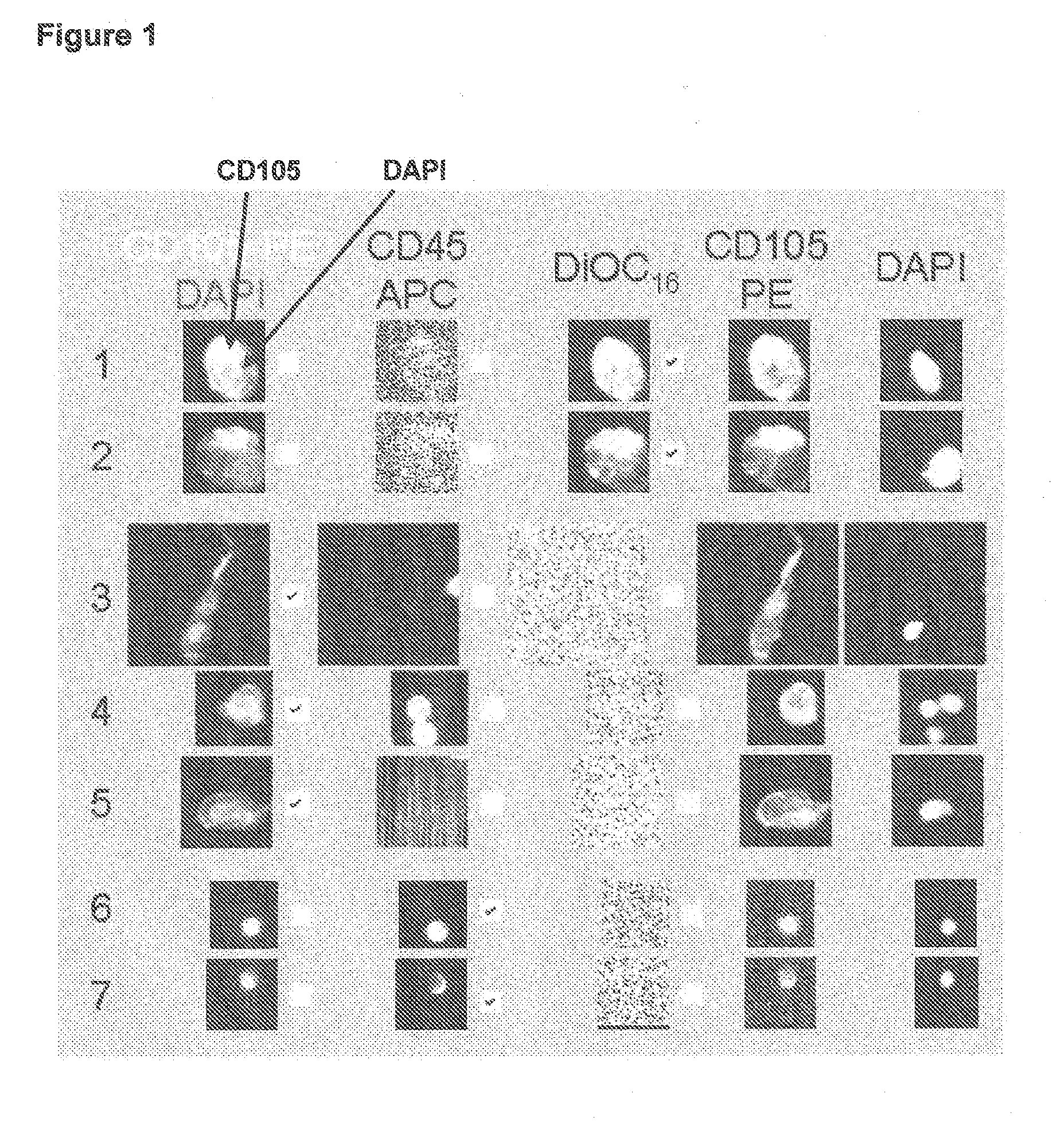 Method of assessing metastatic carcinomas from circulating endothelial cells and disseminated tumor cells