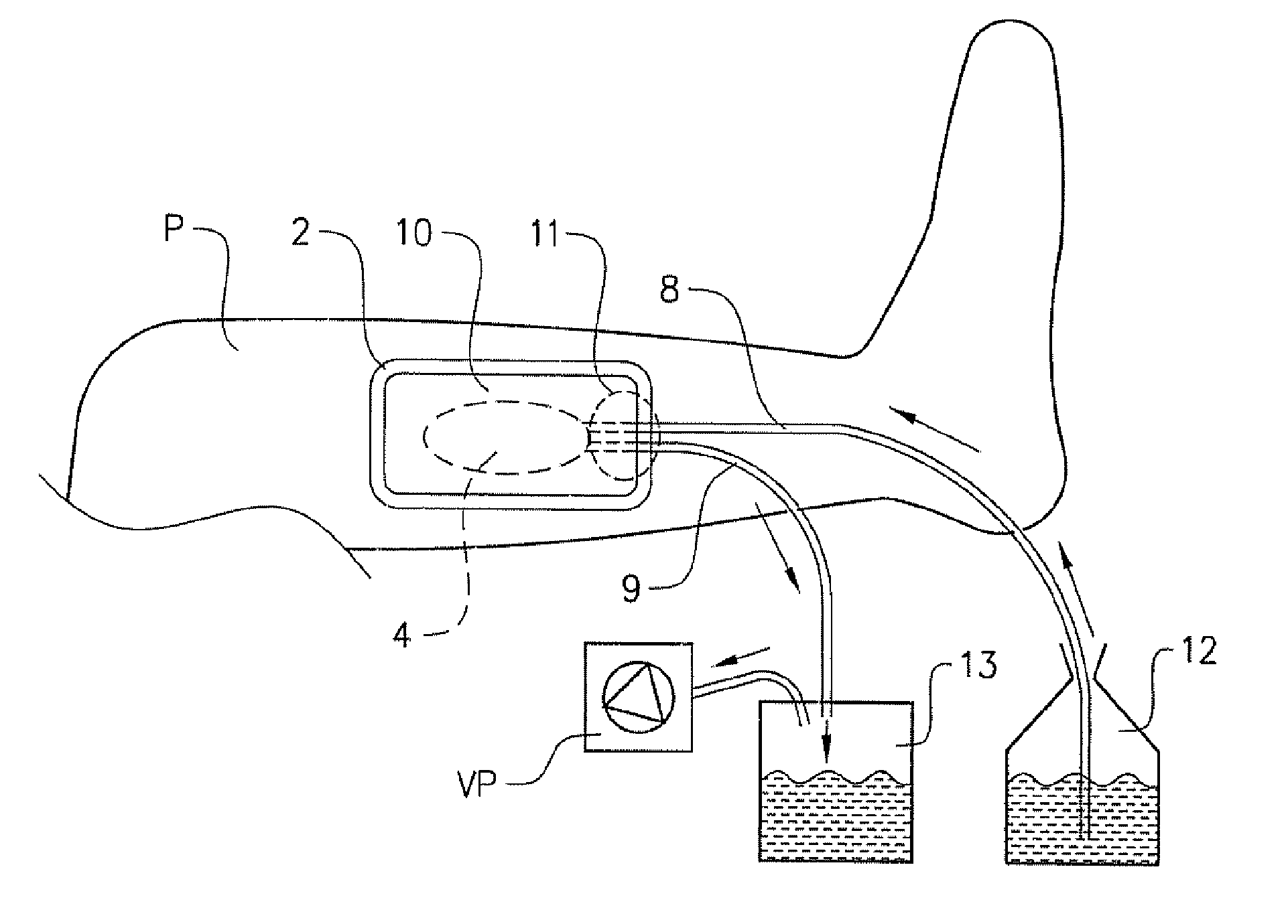 Wound dressing having pressure-distributing tube inlet