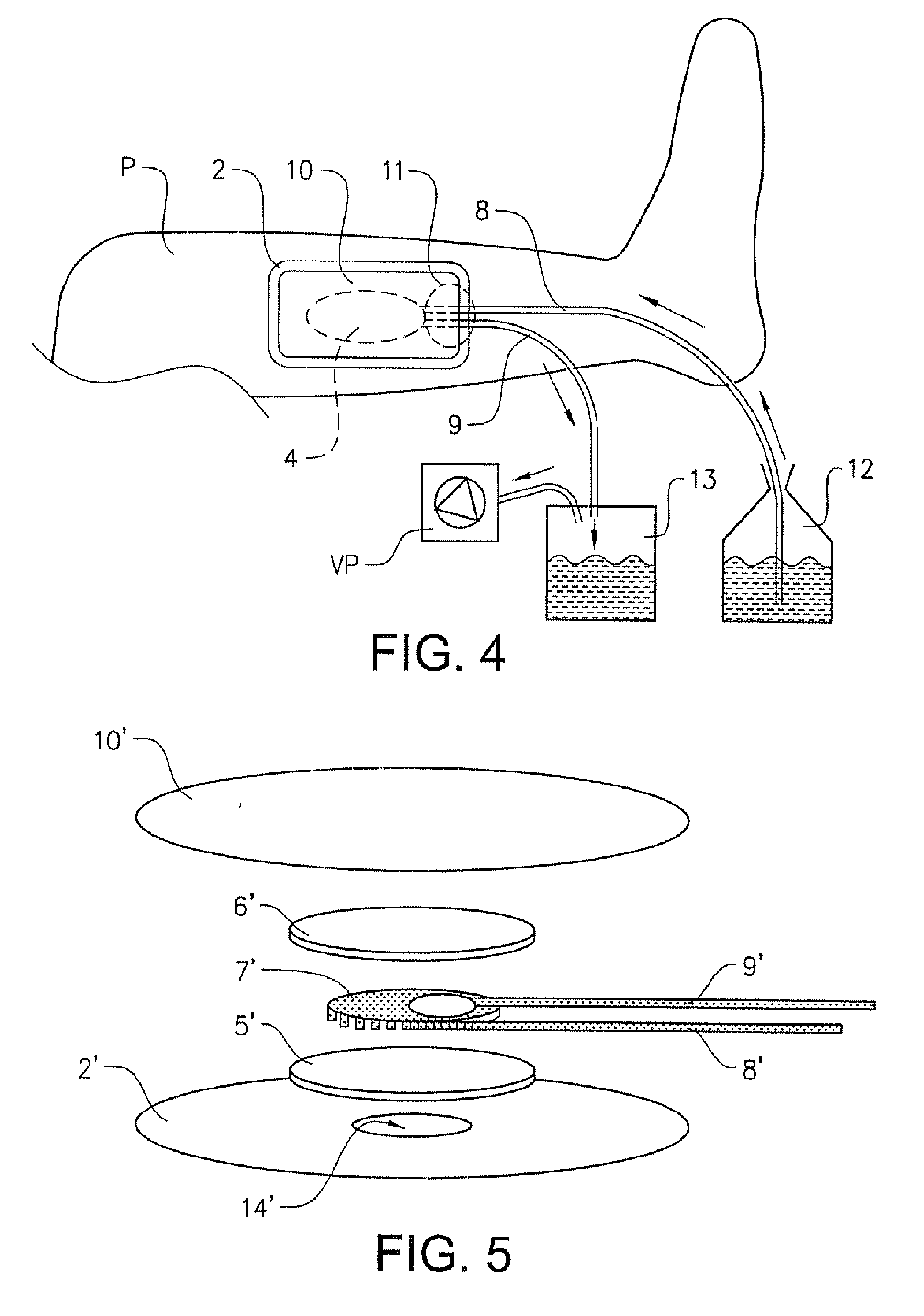 Wound dressing having pressure-distributing tube inlet