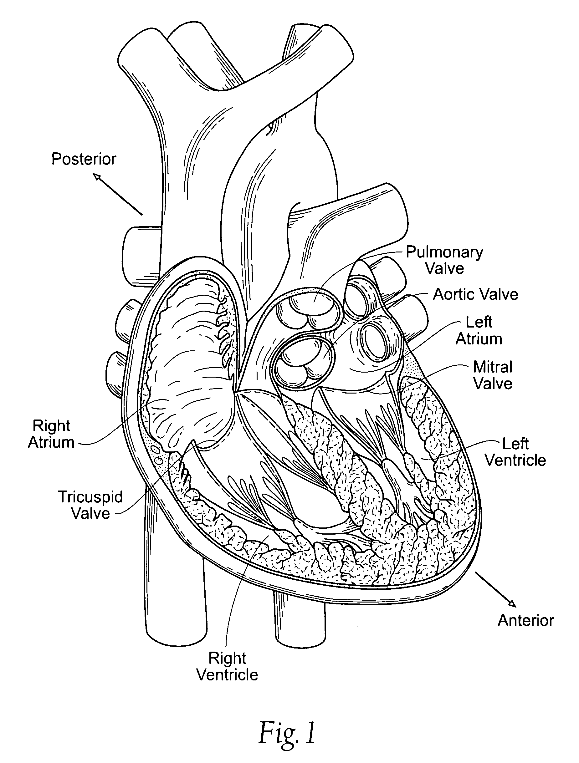 Devices, systems, and methods for reshaping a heart valve annulus, including the use of magnetic tools