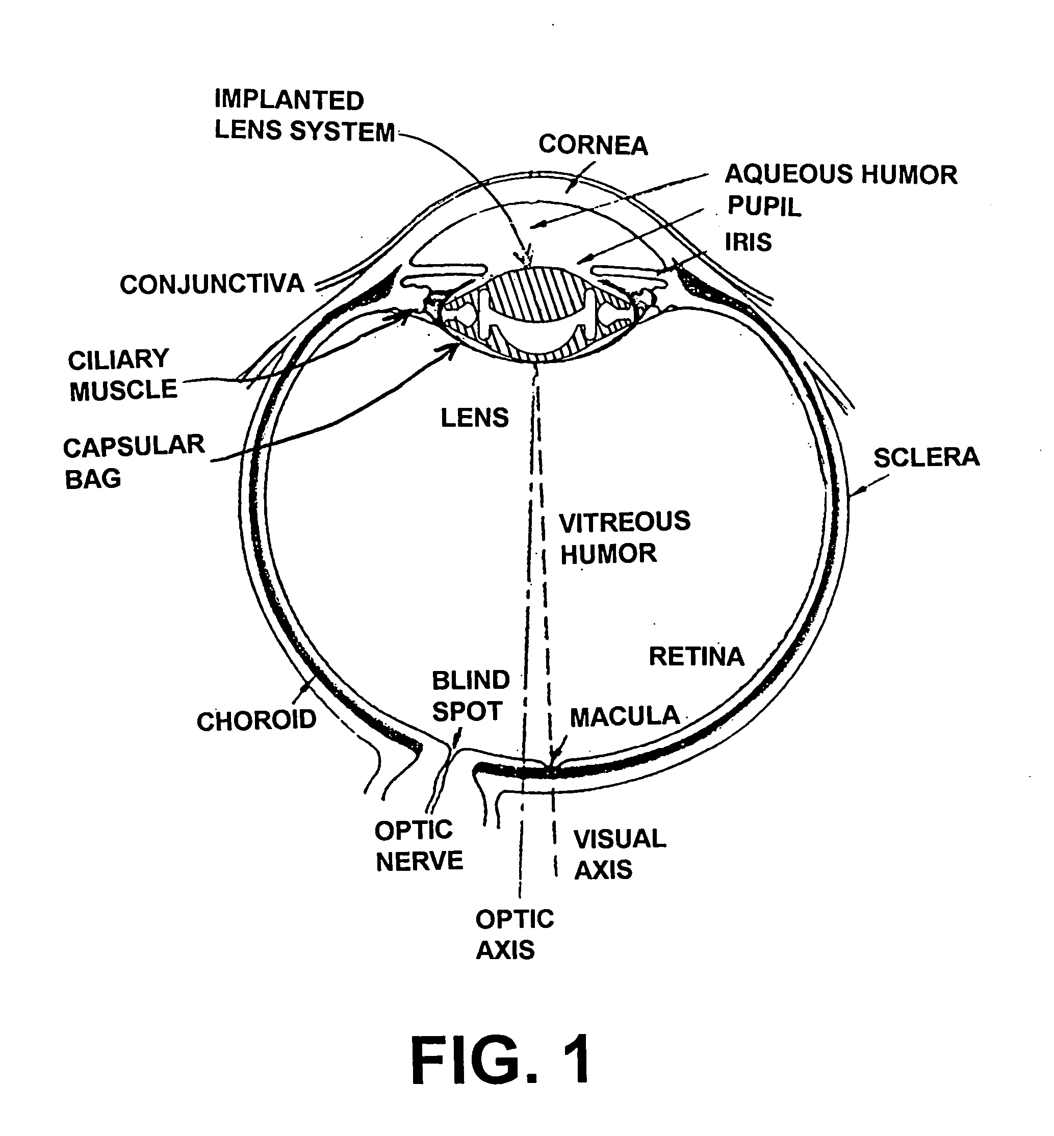 High gain wide range accommodating intraocular lens for implant into the capsular bag