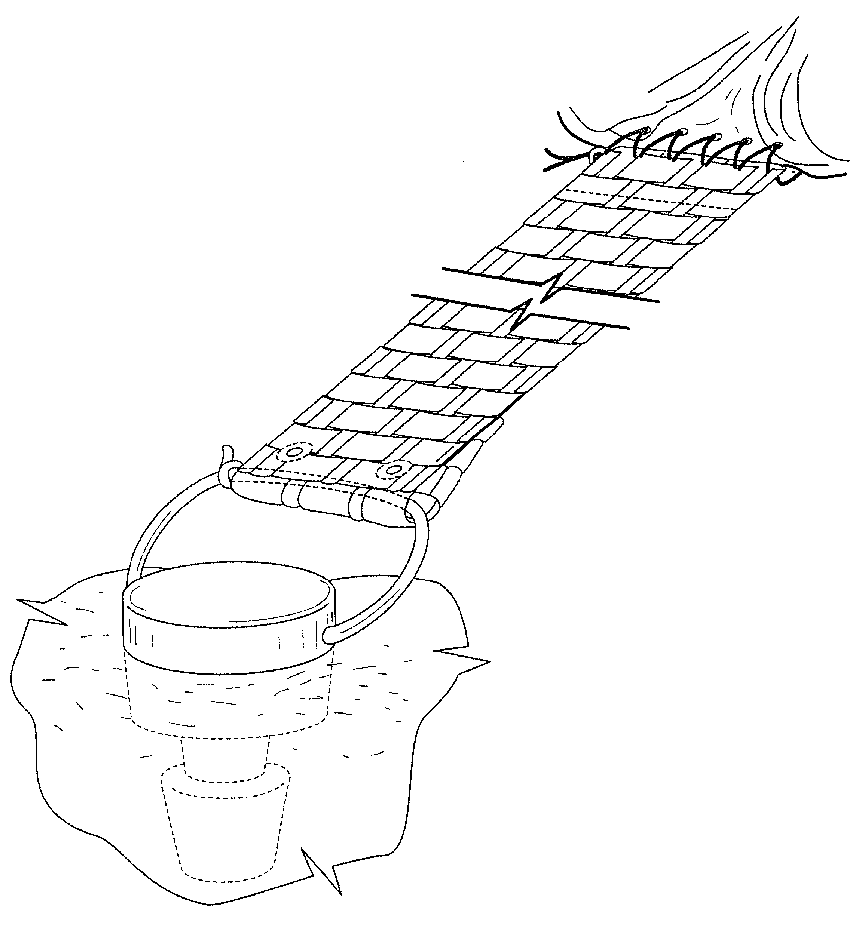 Woven and/or braided fiber implants and methods of making same