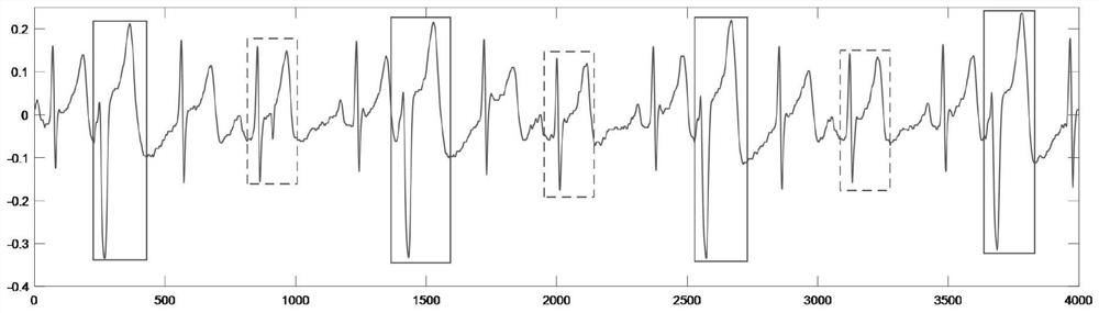 Electrocardiosignal premature beat detection method for