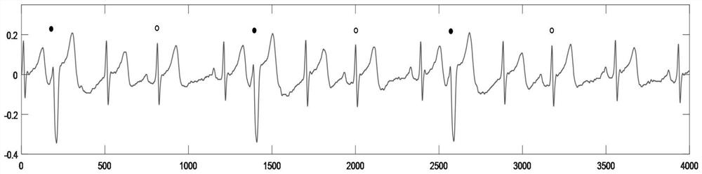 Electrocardiosignal premature beat detection method for