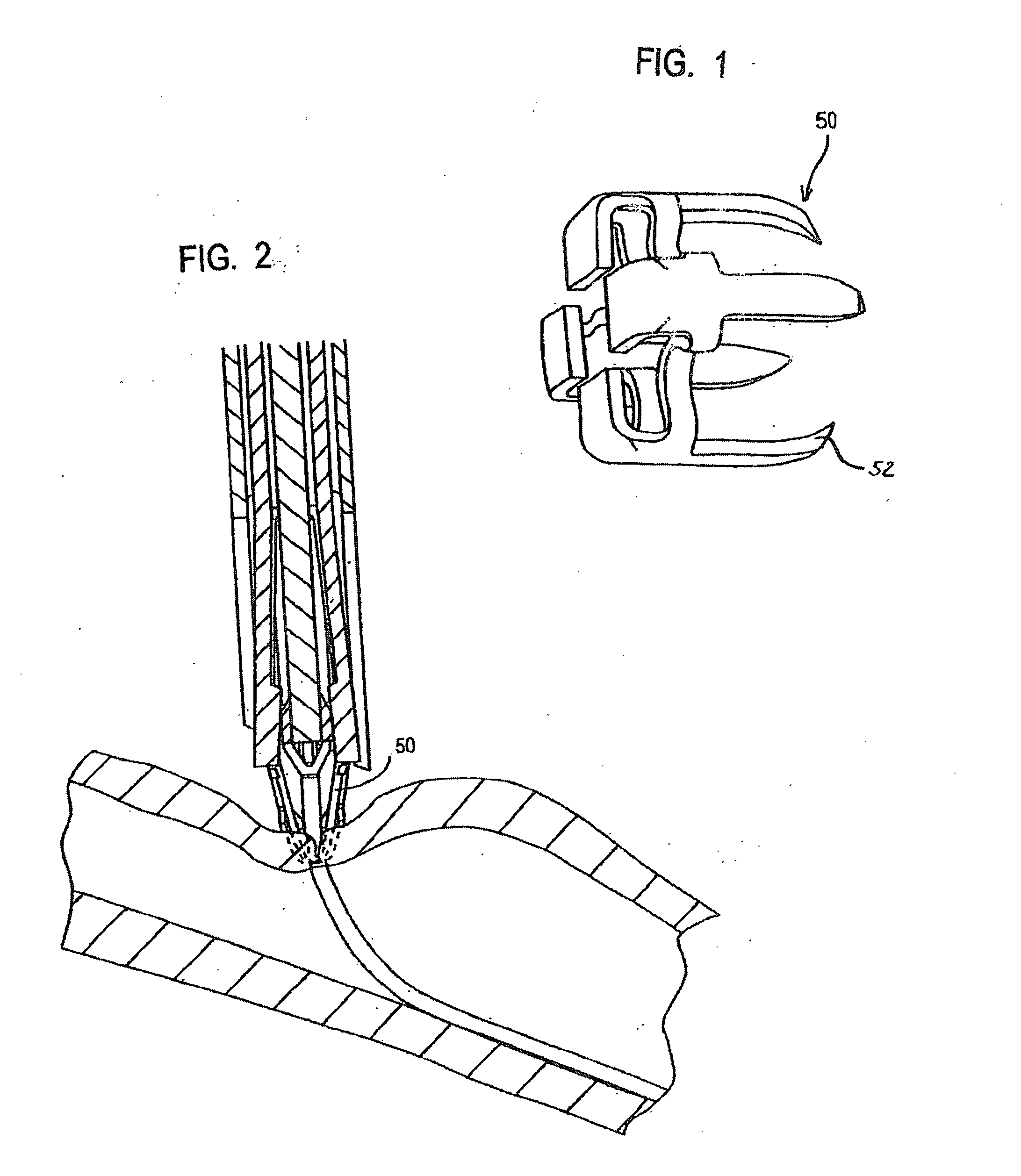 Biodegradable and/or bioabsorbable member for vascular sealing