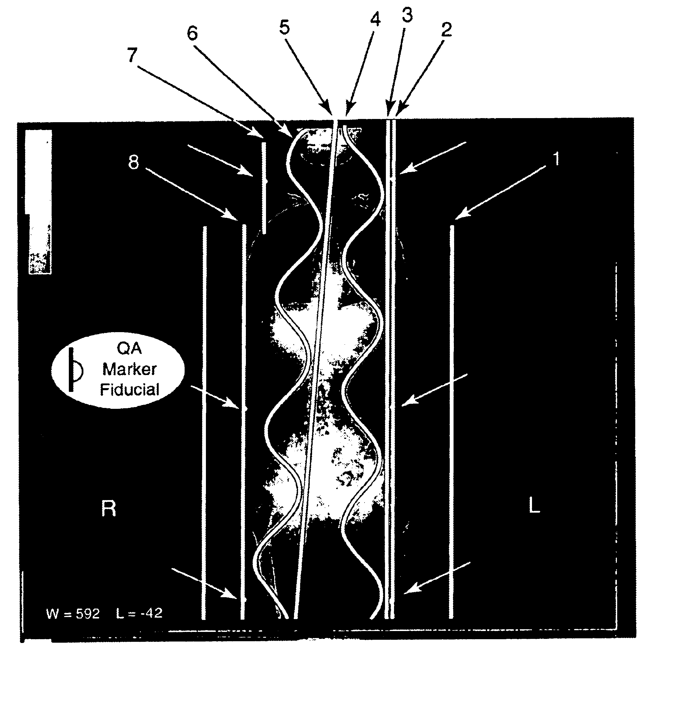 Whole body stereotactic localization and immobilization system