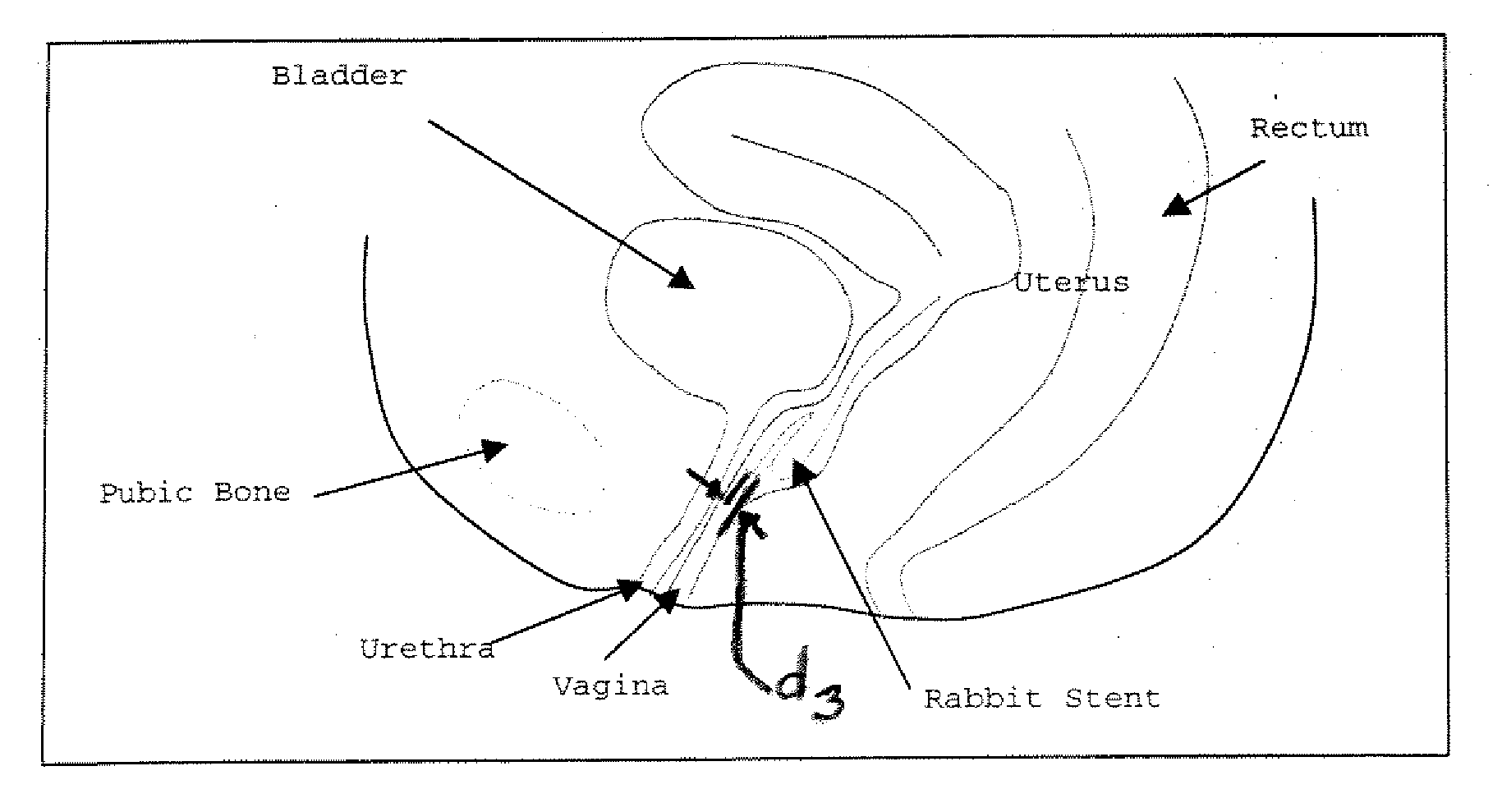 Method of treating urinary incontinence