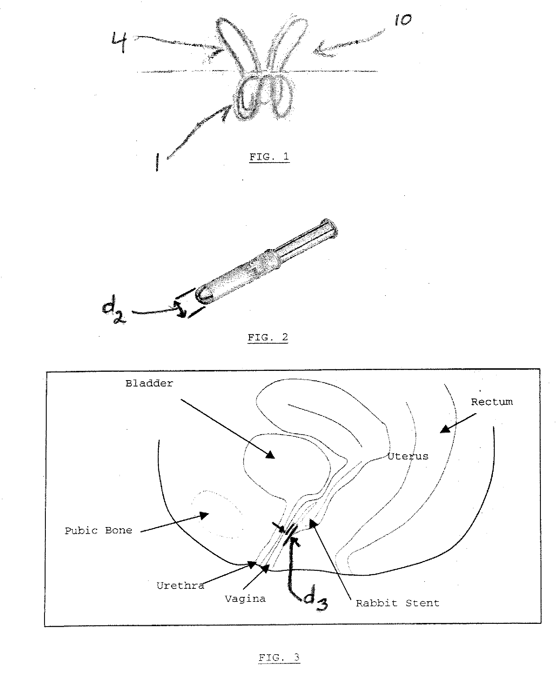 Method of treating urinary incontinence