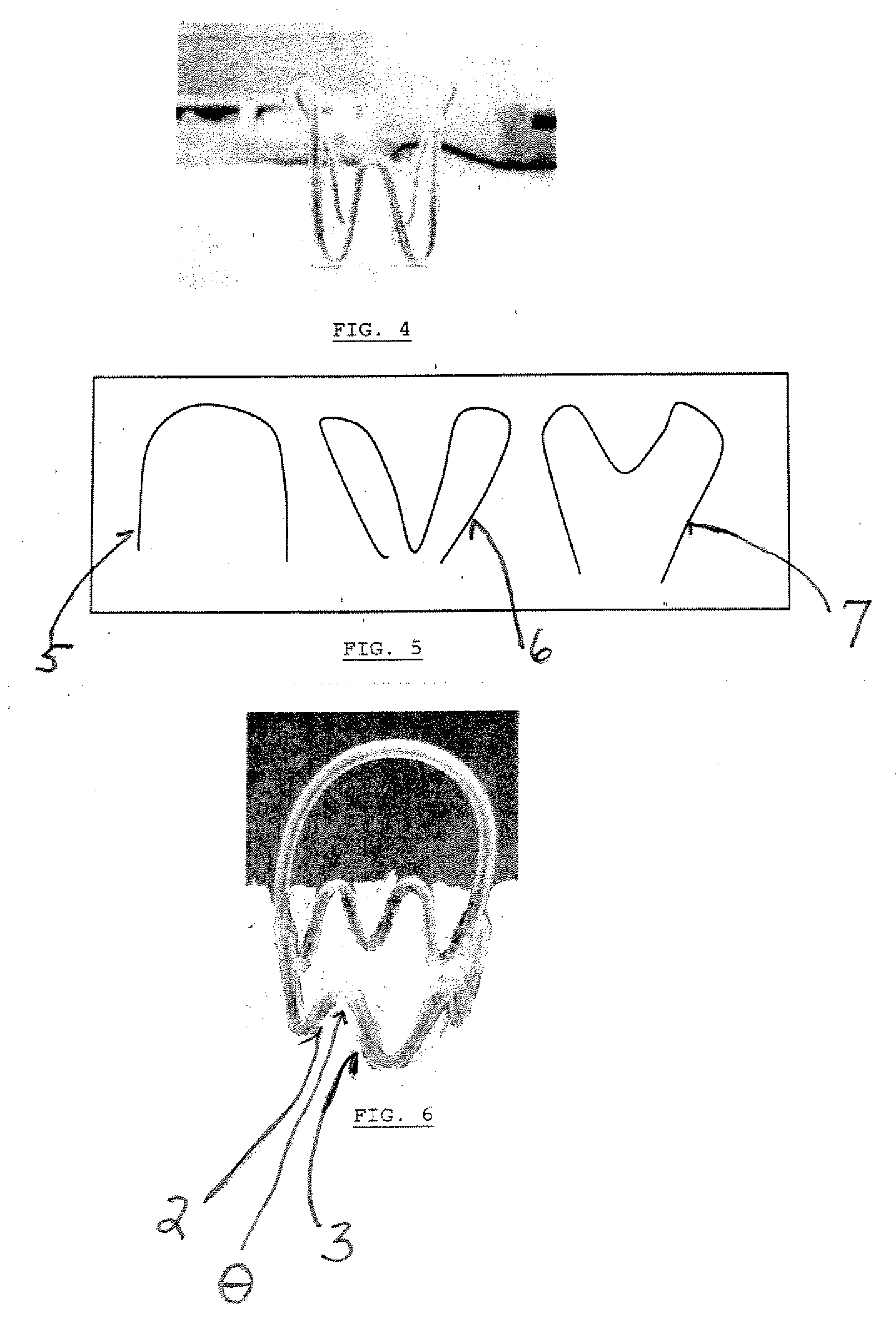 Method of treating urinary incontinence