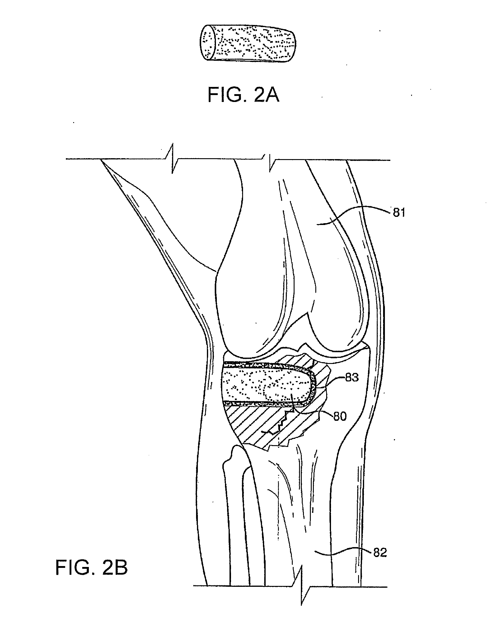 Bioactive antibacterial bone graft materials