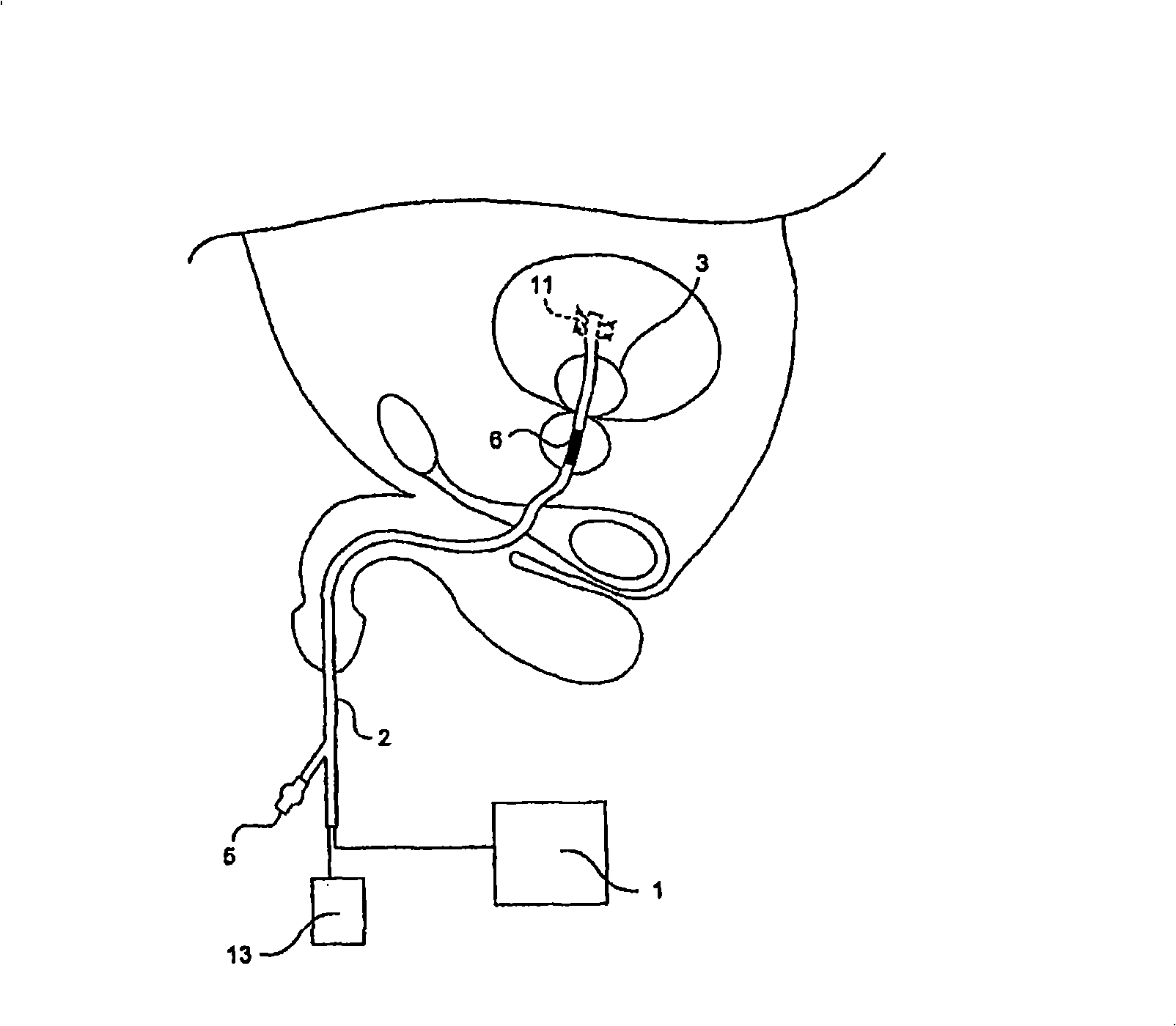 Method and apparatus for photoactivation medicament treatment